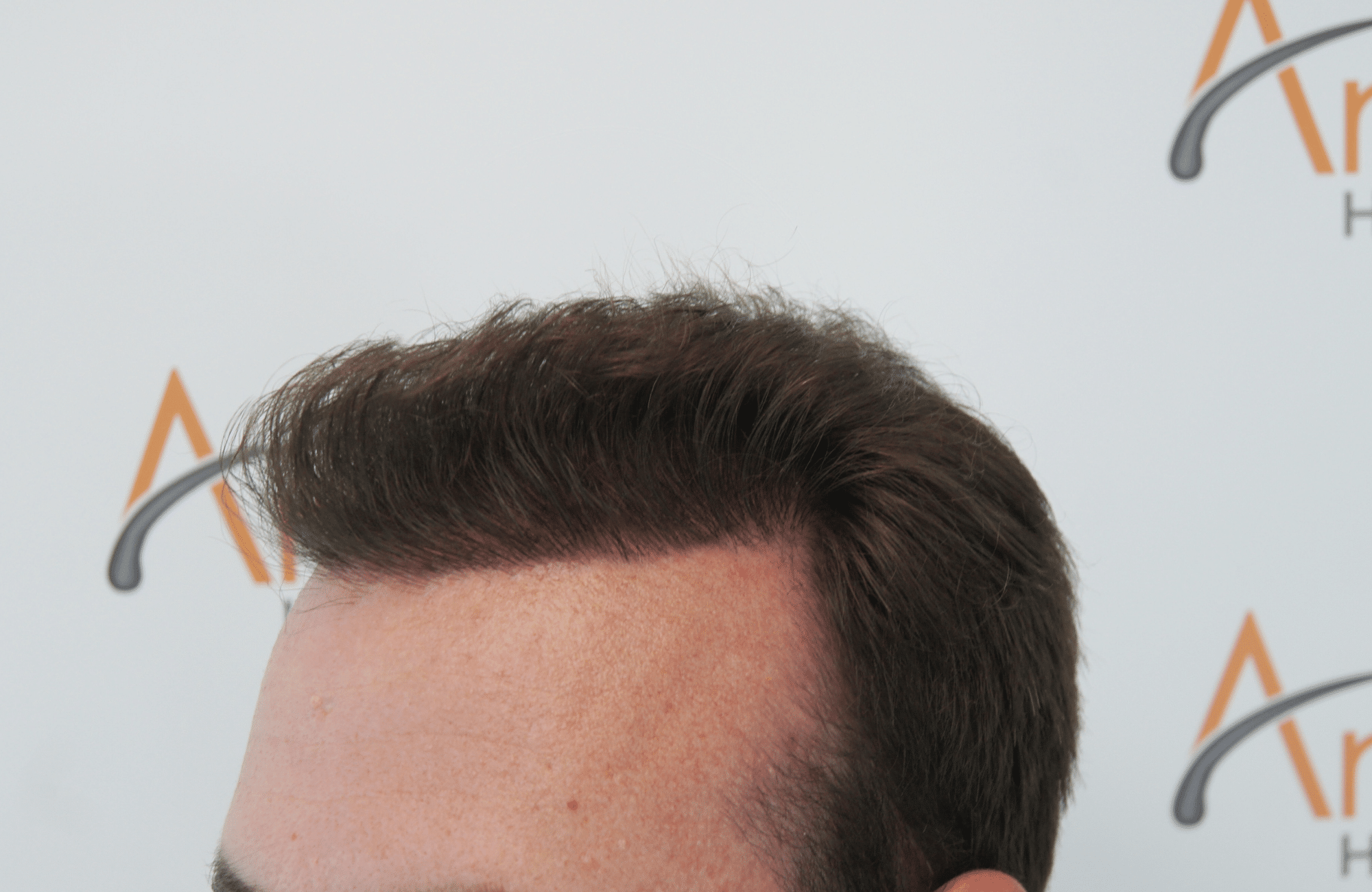 hair transplant result with 3500 fus after - side1