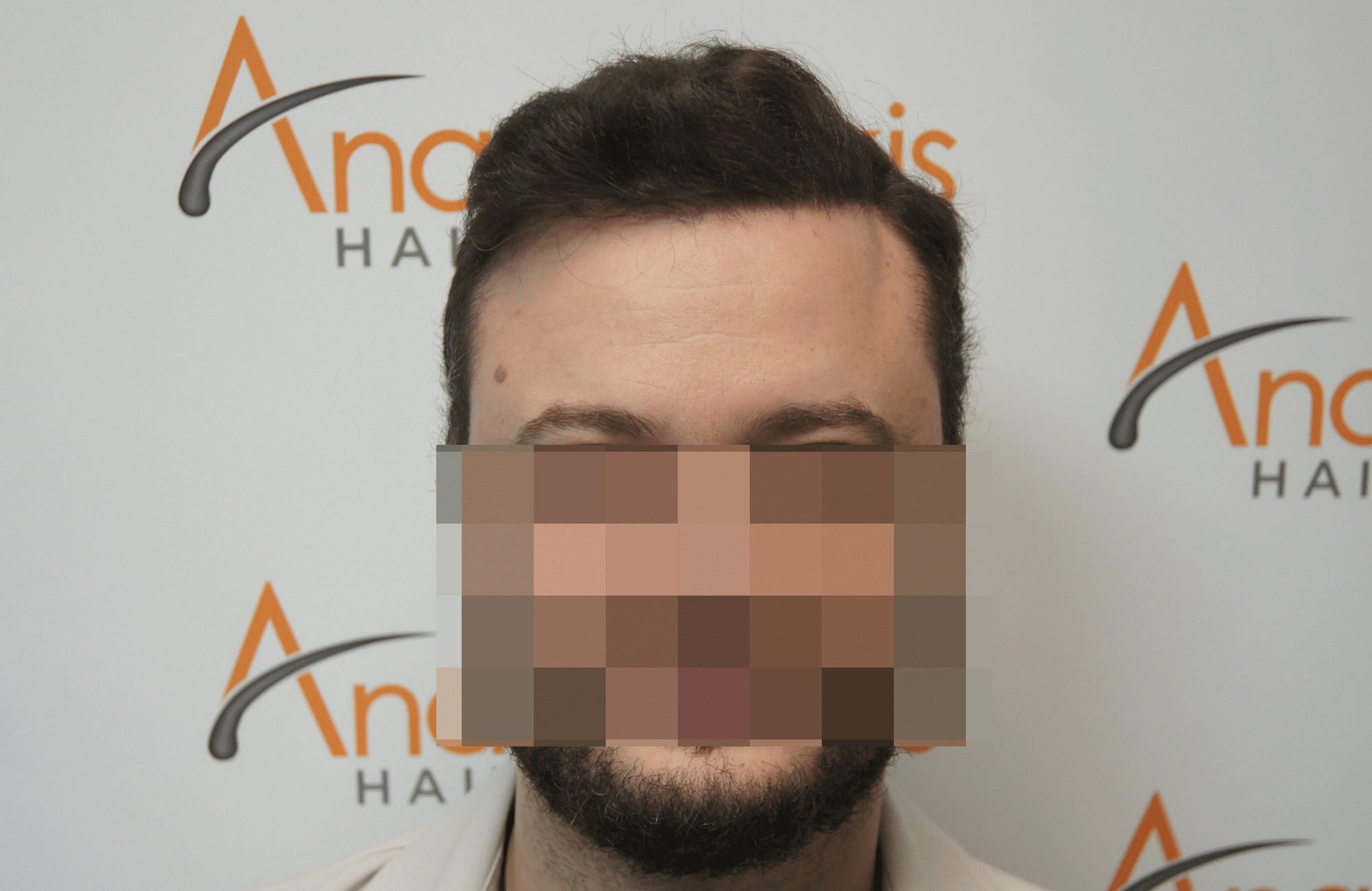 hair transplant result with 3500 fus after - fullface