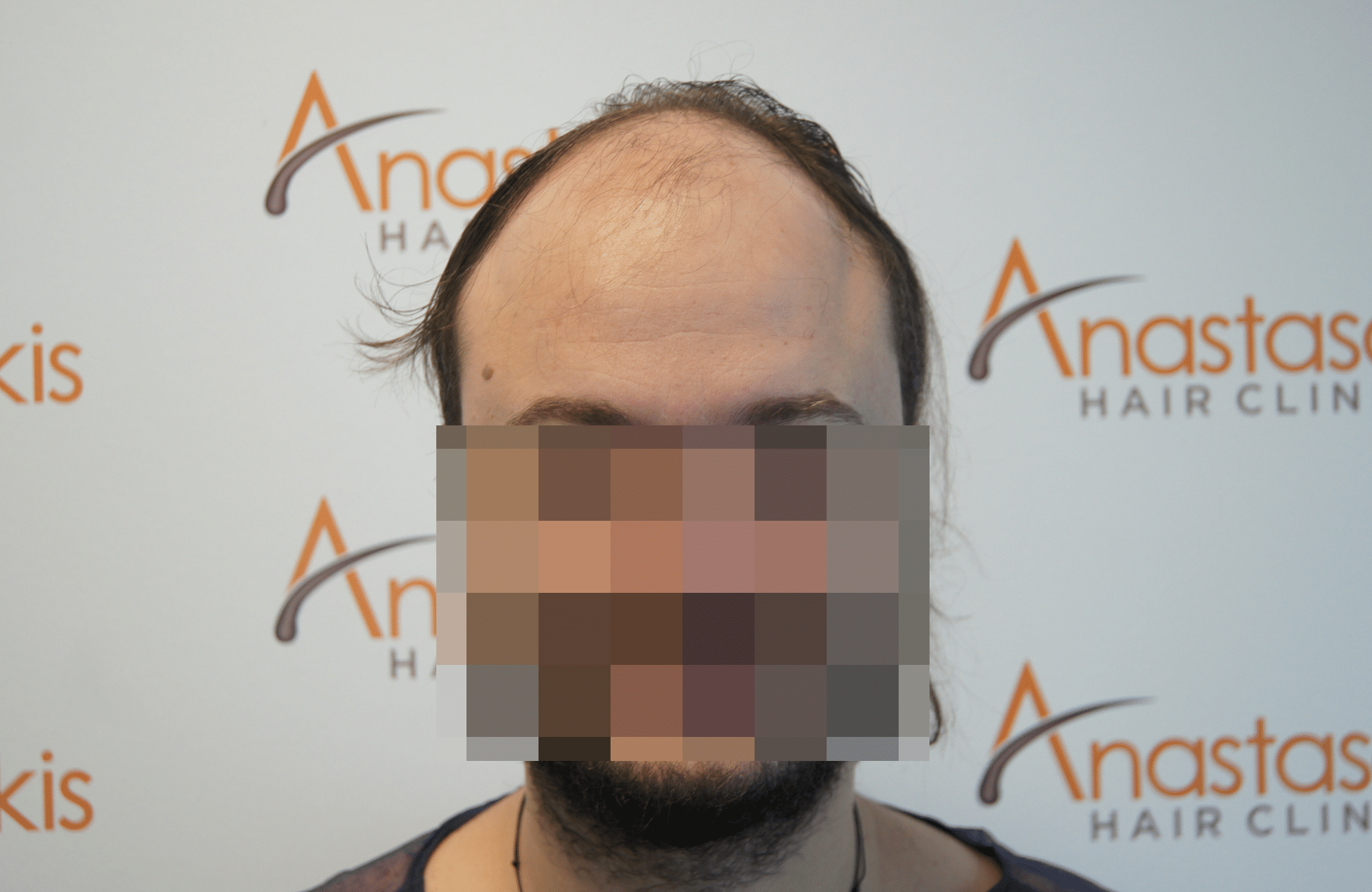hair transplant result with 3500 fus before - fullface