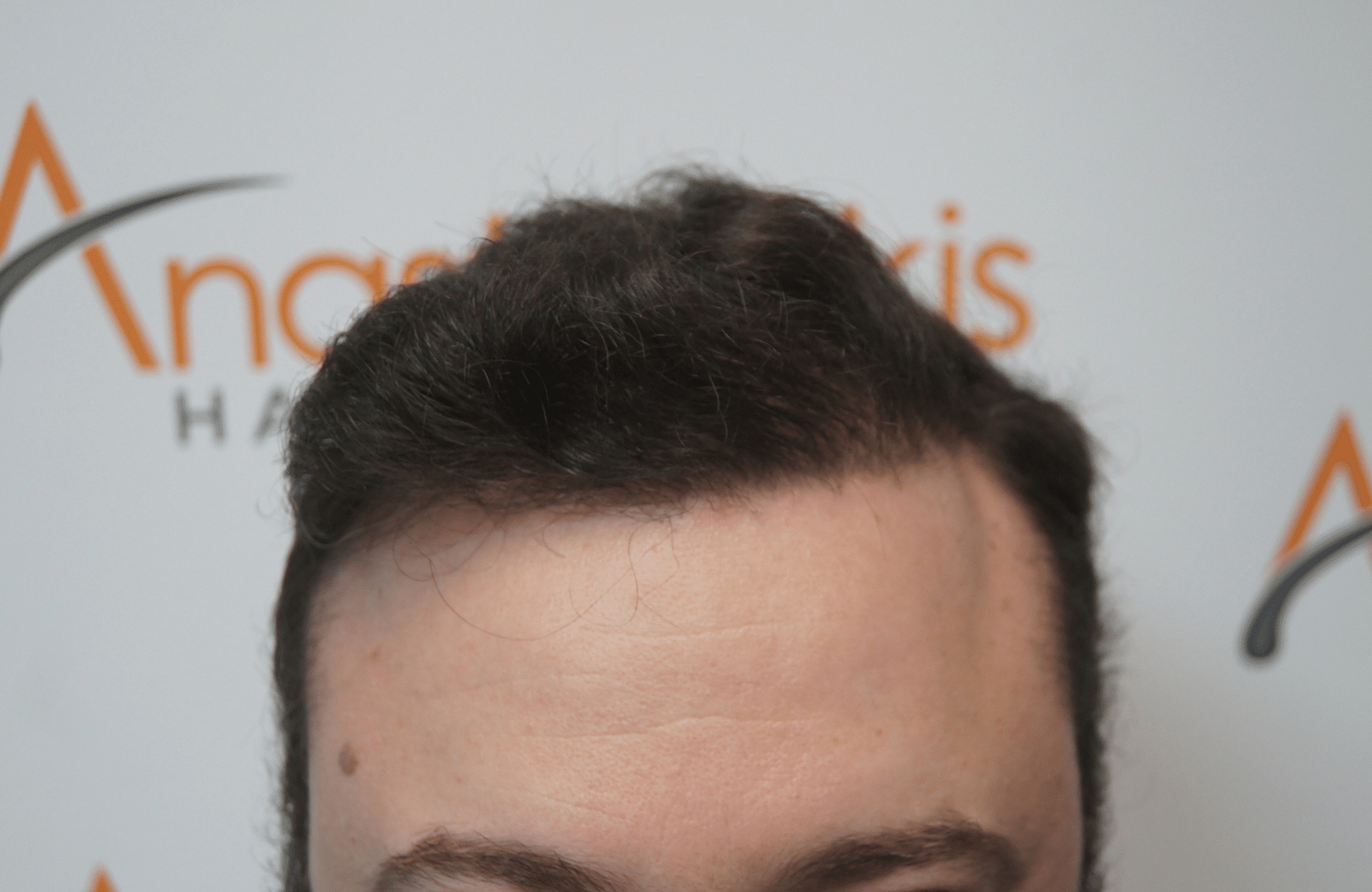 hair transplant result with 3500 fus after - hairline