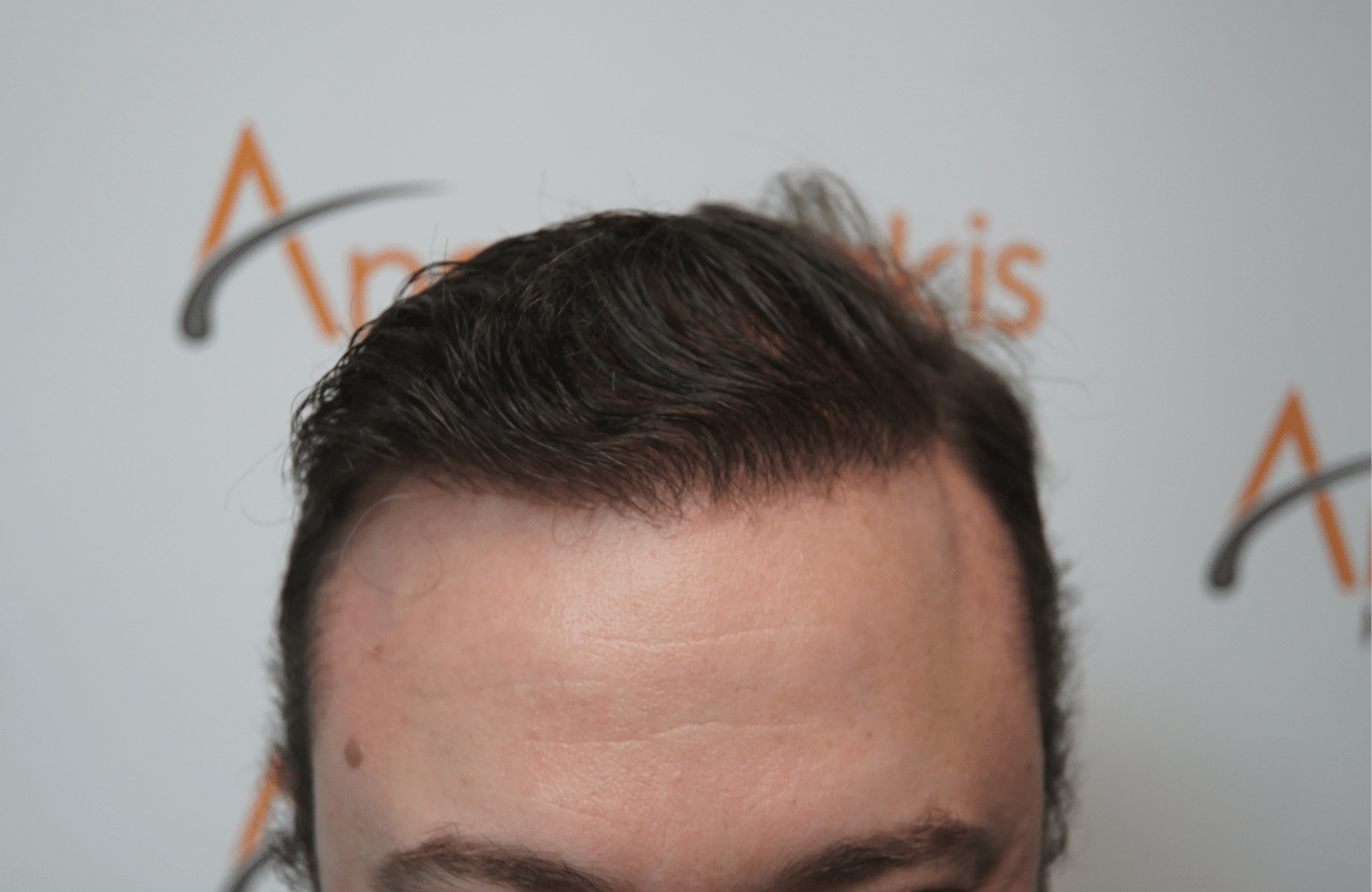 hair transplant result with 3500 fus after - hairline wet hair