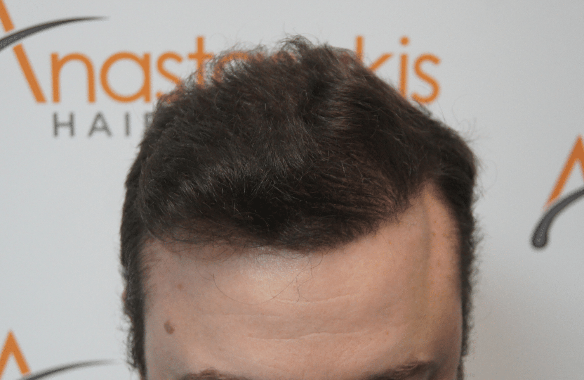 hair transplant result with 3500 fus after - frontal