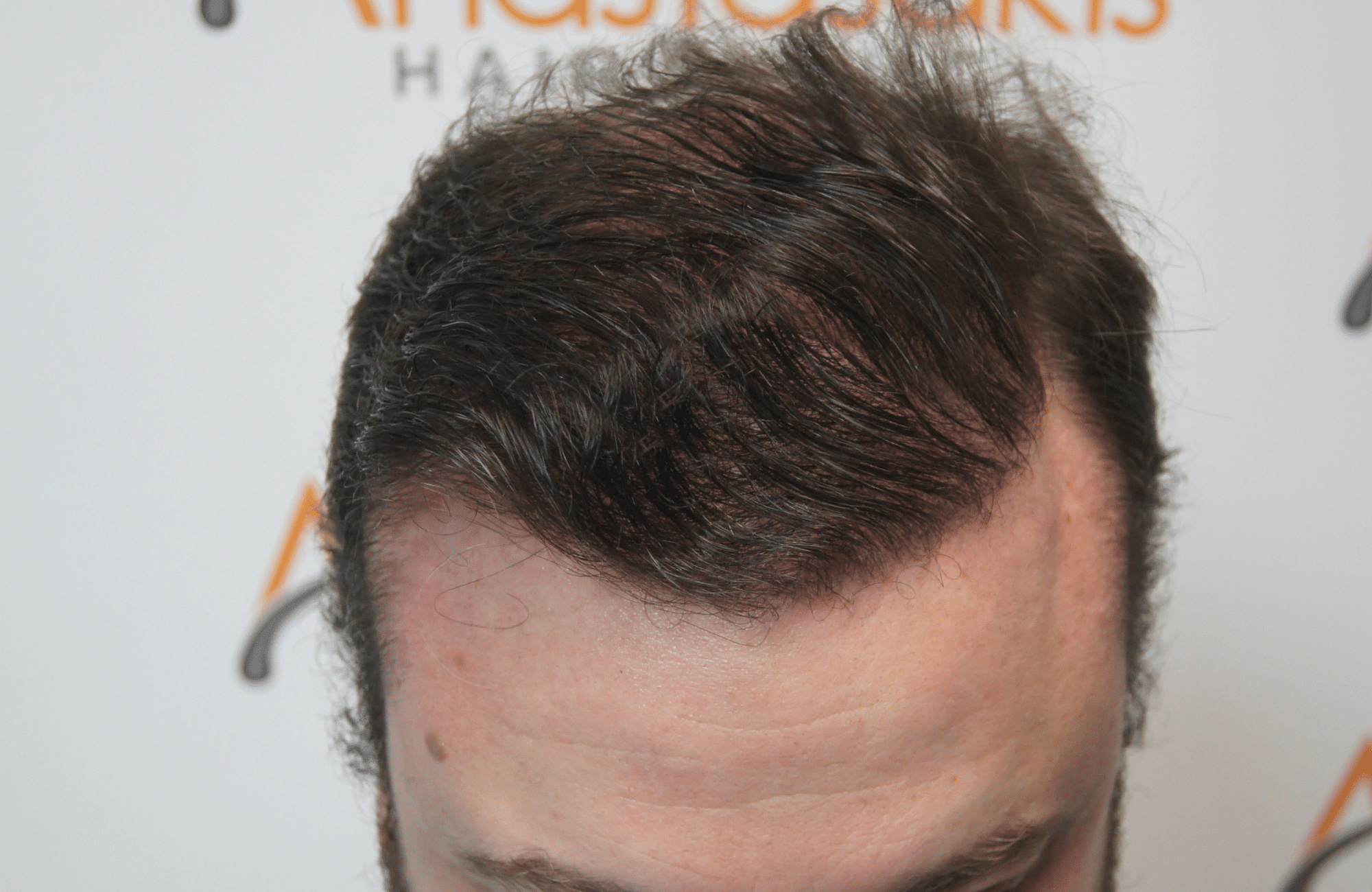 hair transplant result with 3500 fus after - frontal wet hair