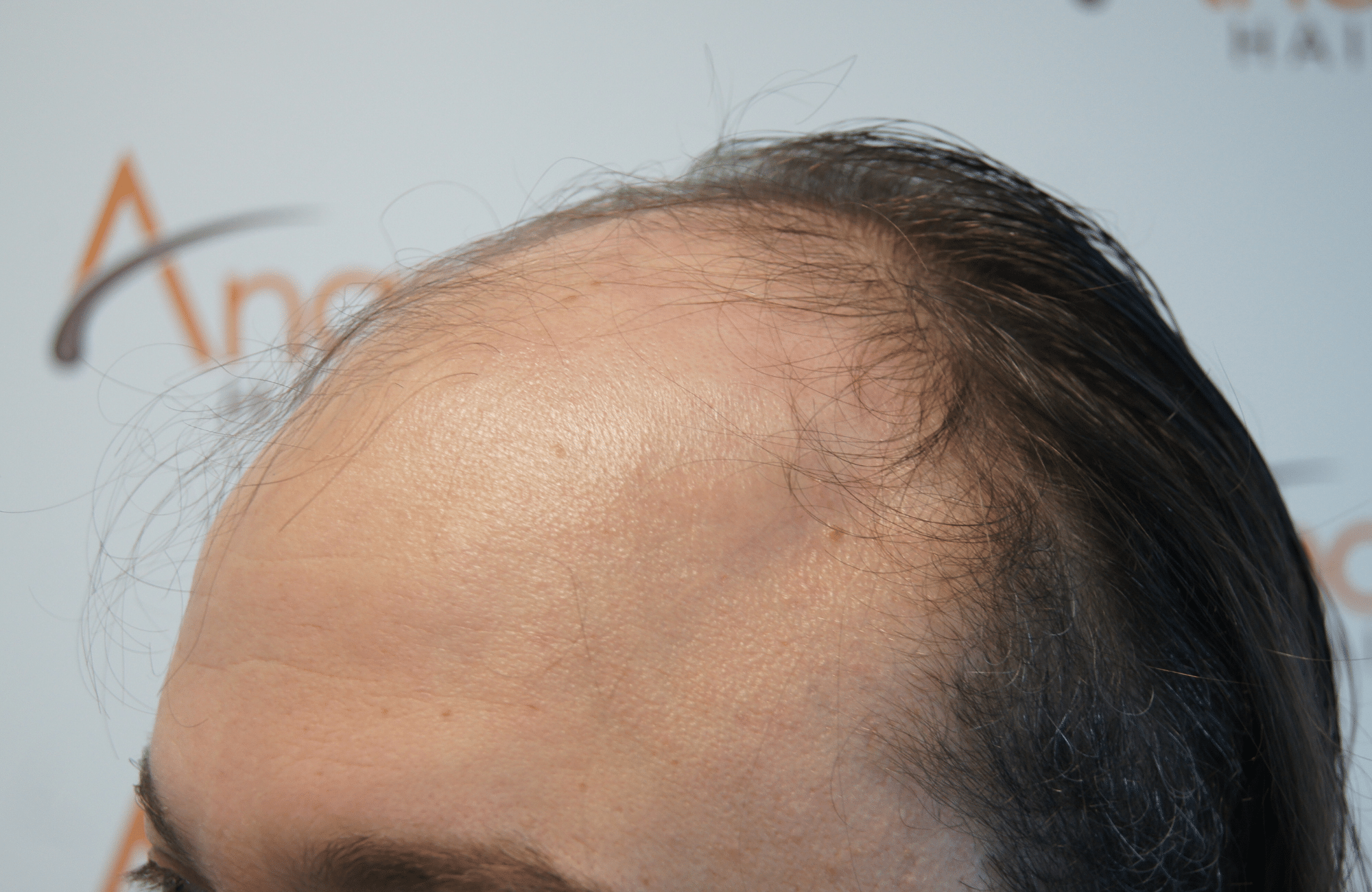 hair transplant result with 3500 fus before - side1