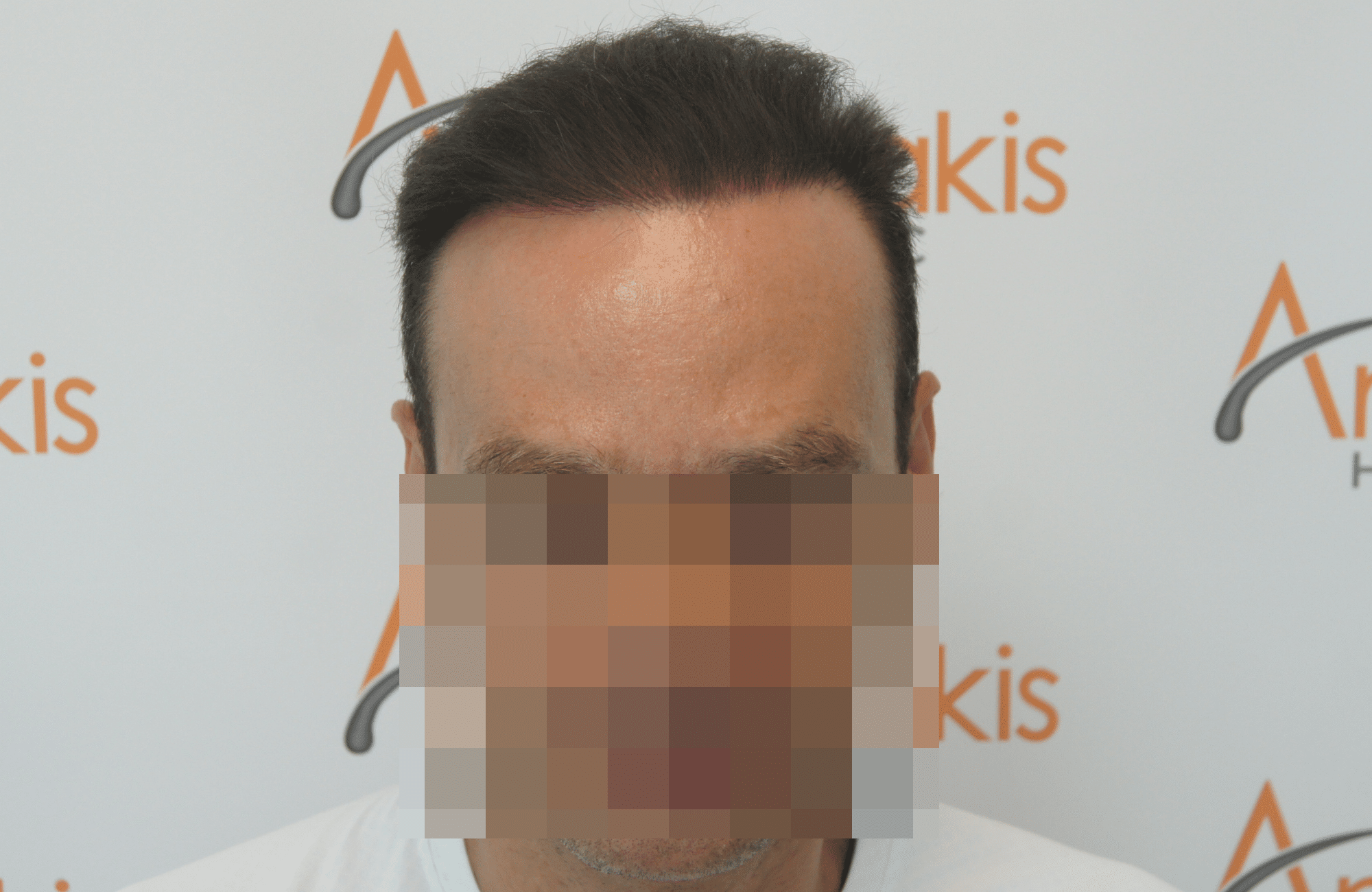 hair transplant patient repair result with 2800 fus after - fullface