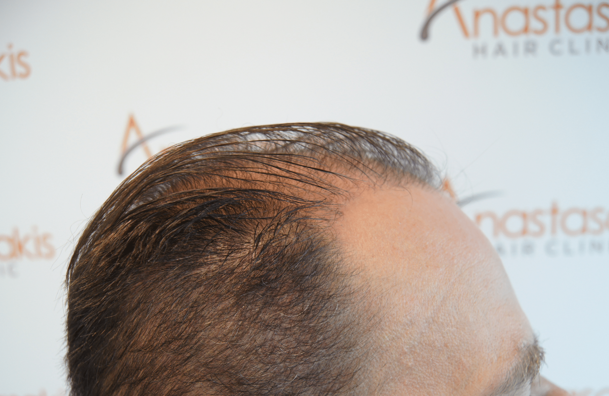 hair transplant patient repair result with 2800 fus before - side4
