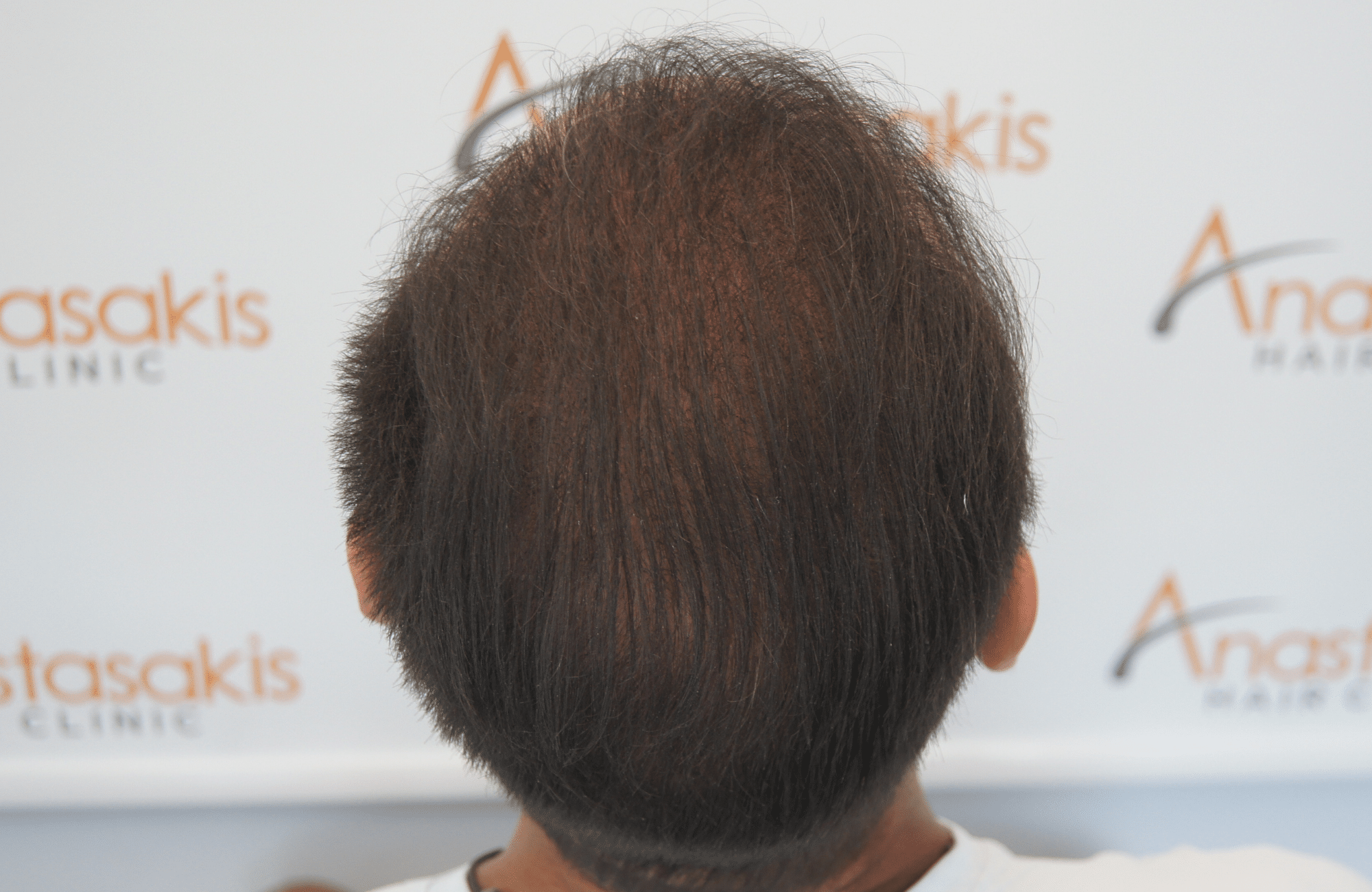 hair transplant patient repair result with 2800 fus after - crown