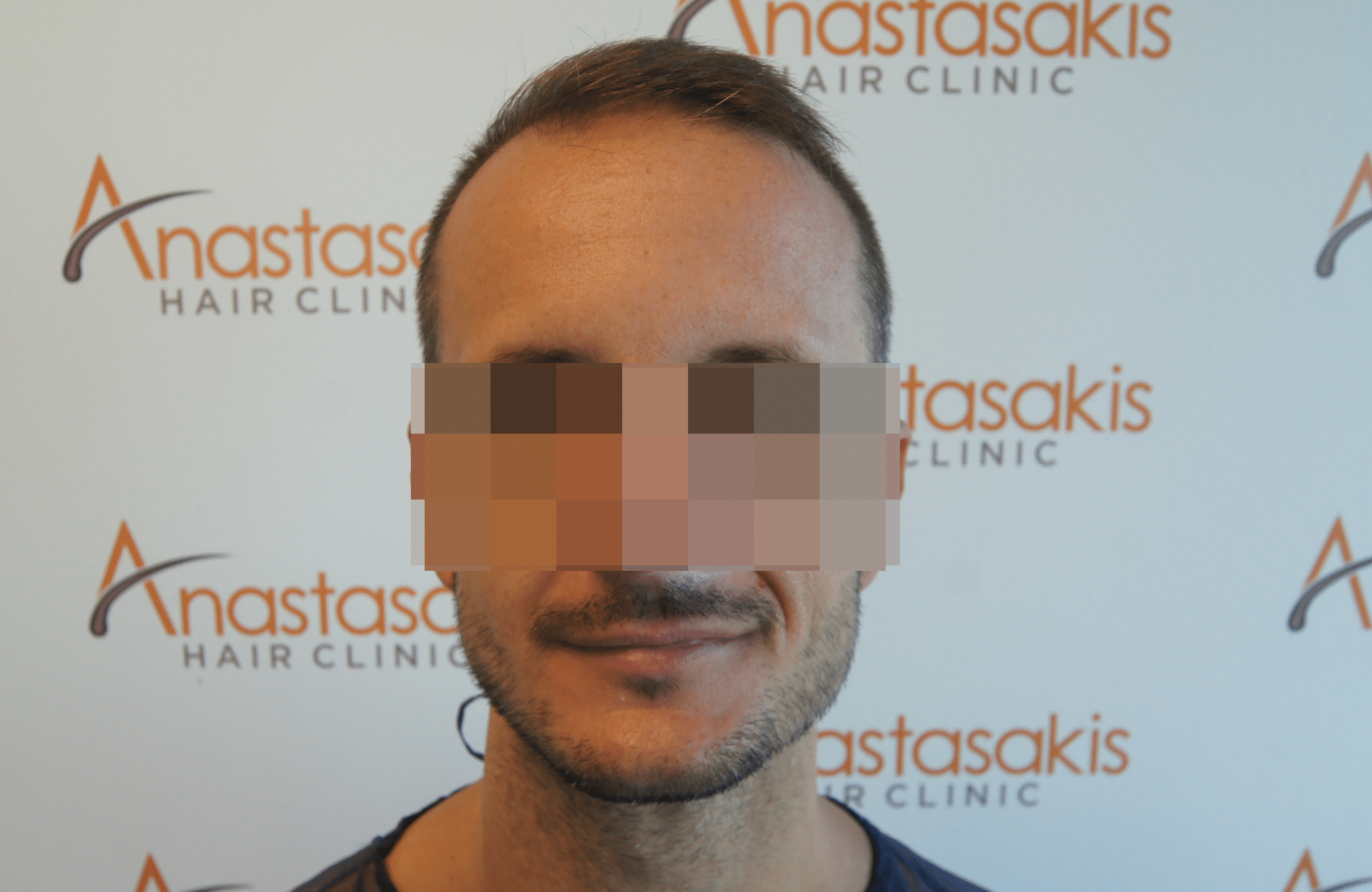 beard transplant result with 1000 follicular units - before fullface