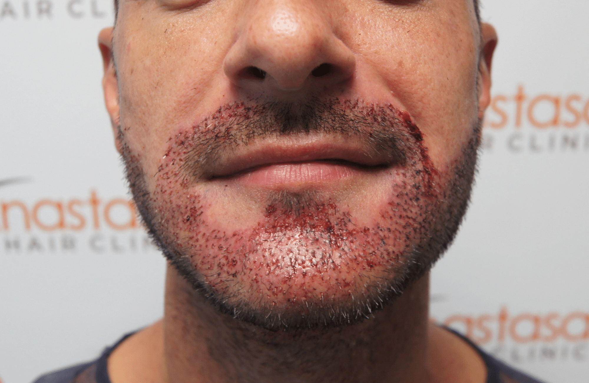 beard transplant result with 1000 follicular units - right after jaw
