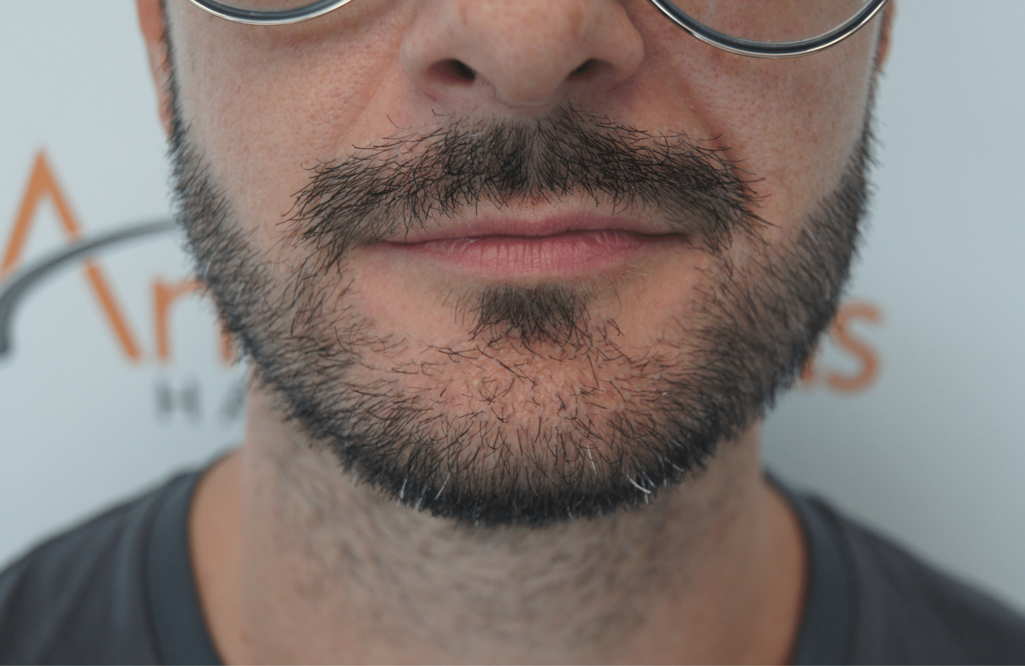 beard transplant result with 1000 follicular units - after jaw