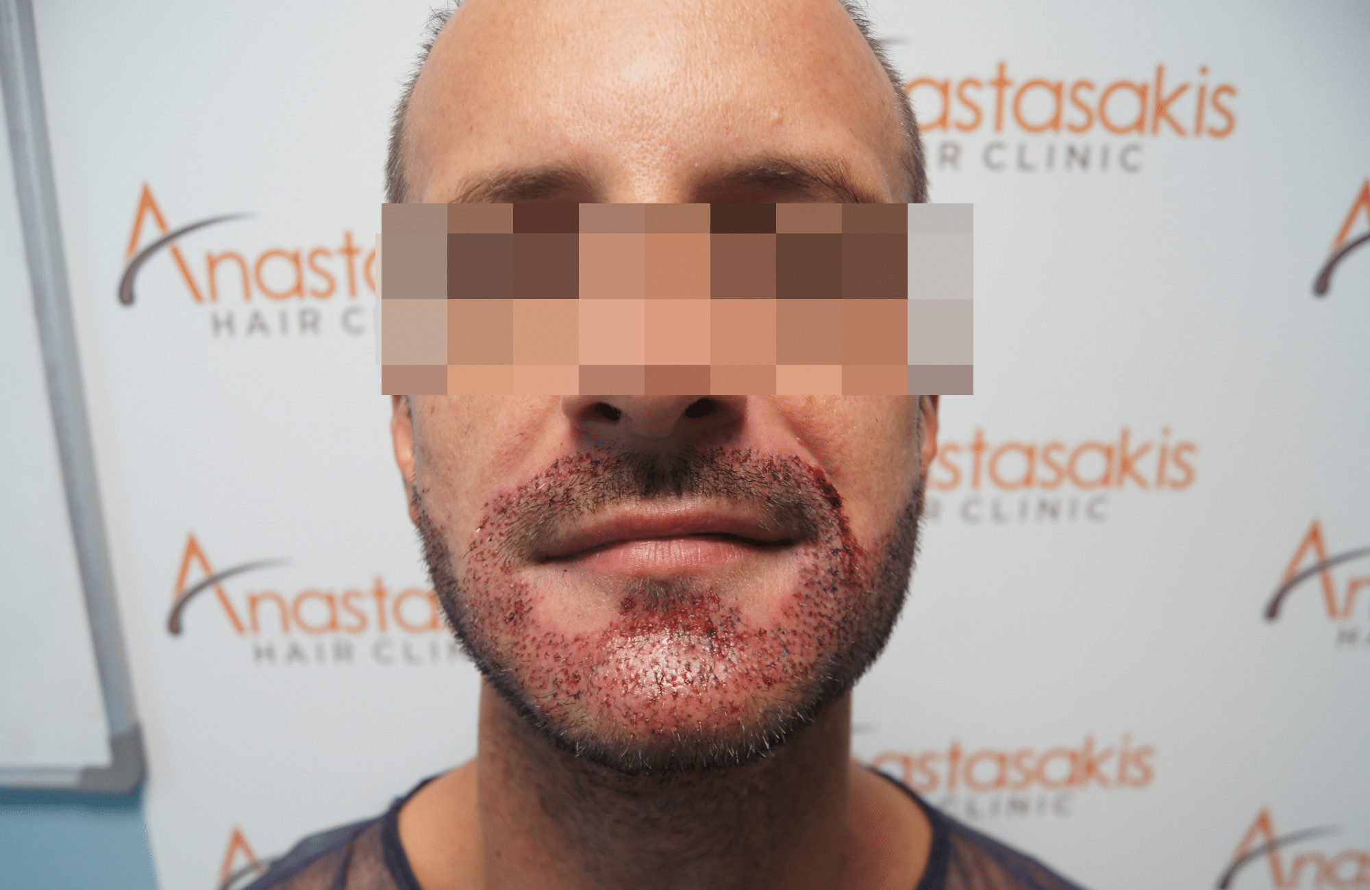 beard transplant result with 1000 follicular units - right after fullface