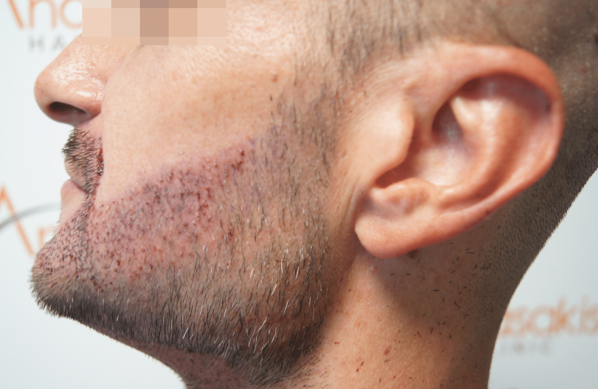 beard transplant result with 1000 follicular units - right after side1