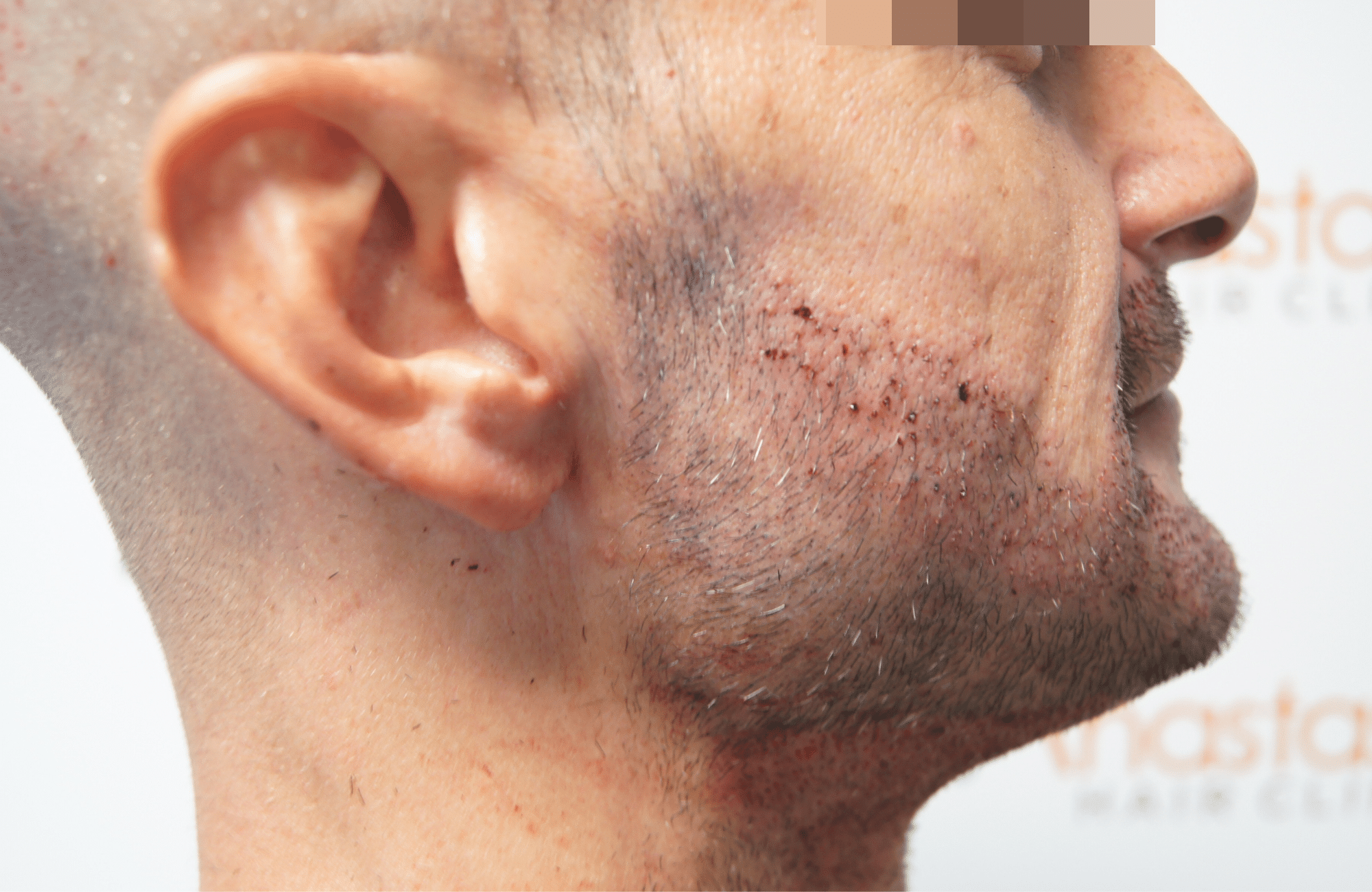 beard transplant result with 1000 follicular units - right after side2