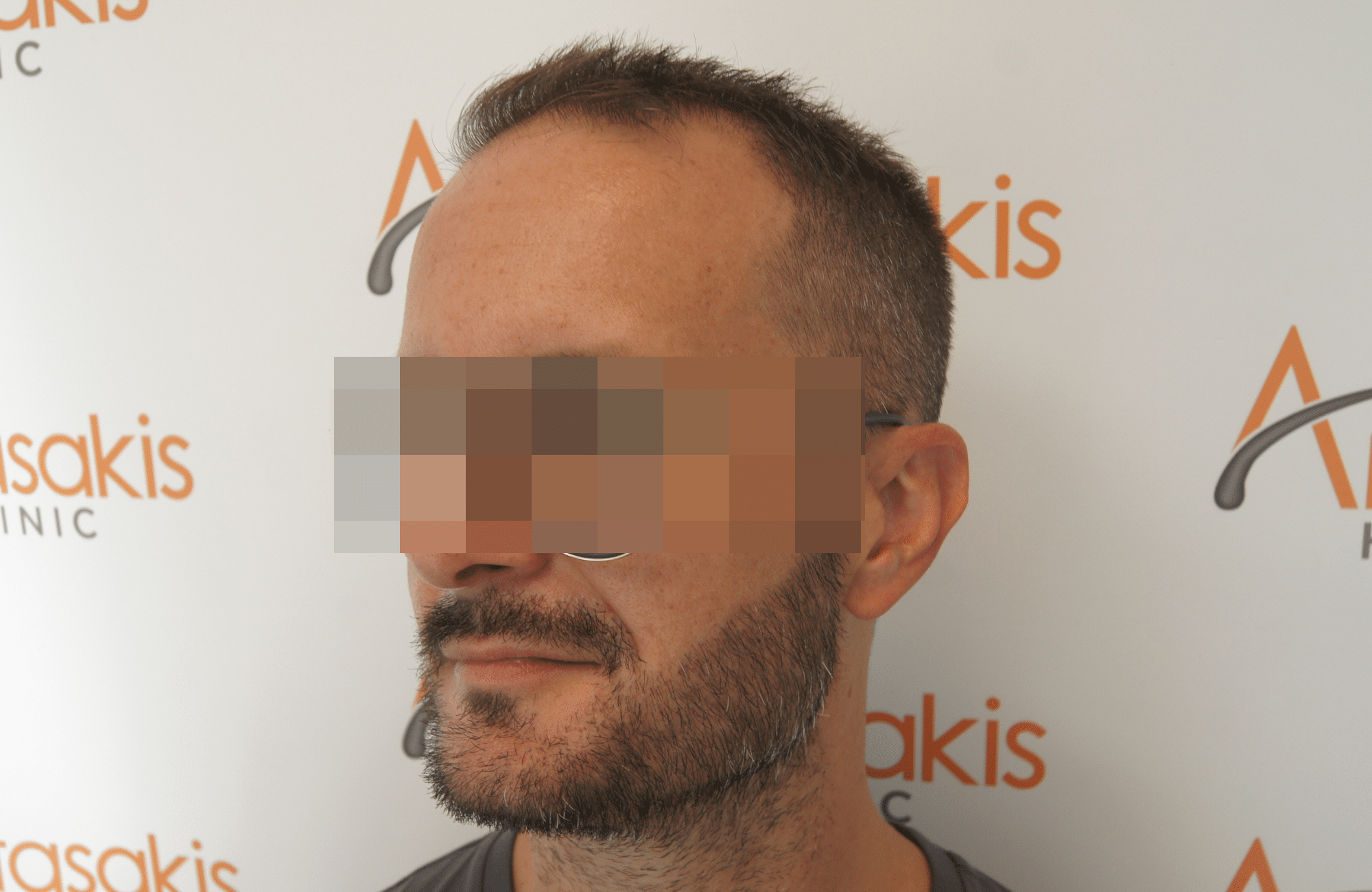 beard transplant result with 1000 follicular units - after side1