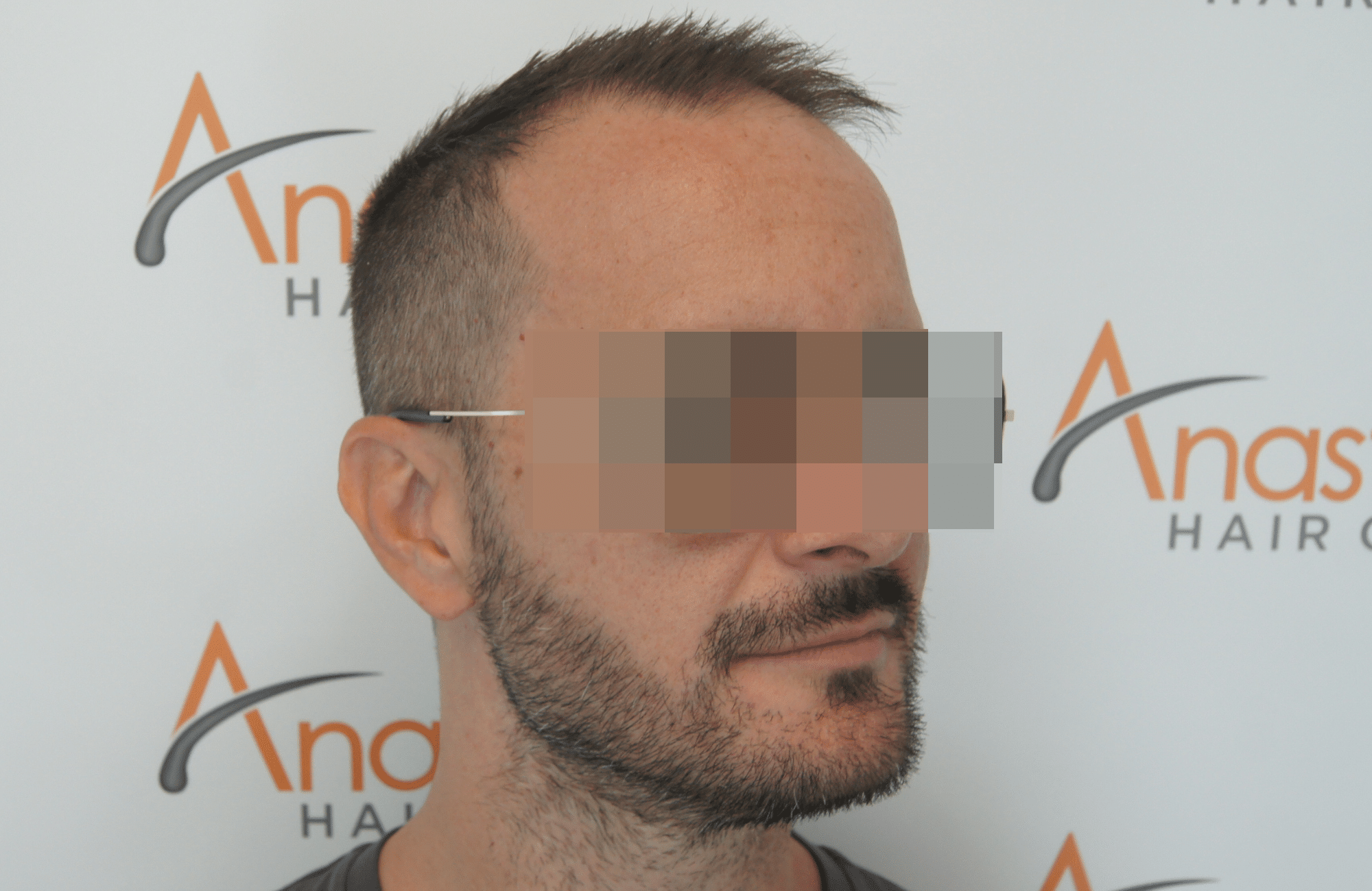 beard transplant result with 1000 follicular units - after side2