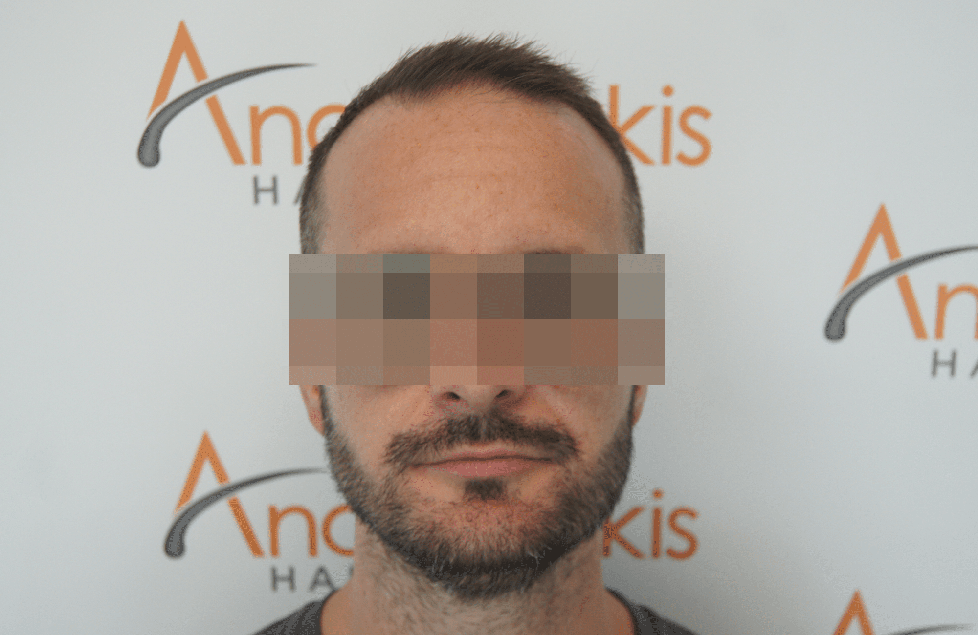 beard transplant result with 1000 follicular units - after fullface