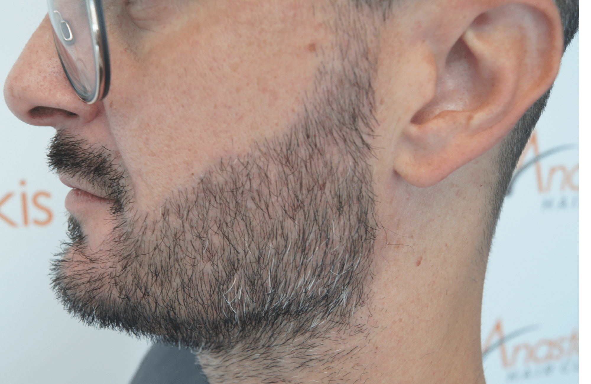 beard transplant result with 1000 follicular units - after side3