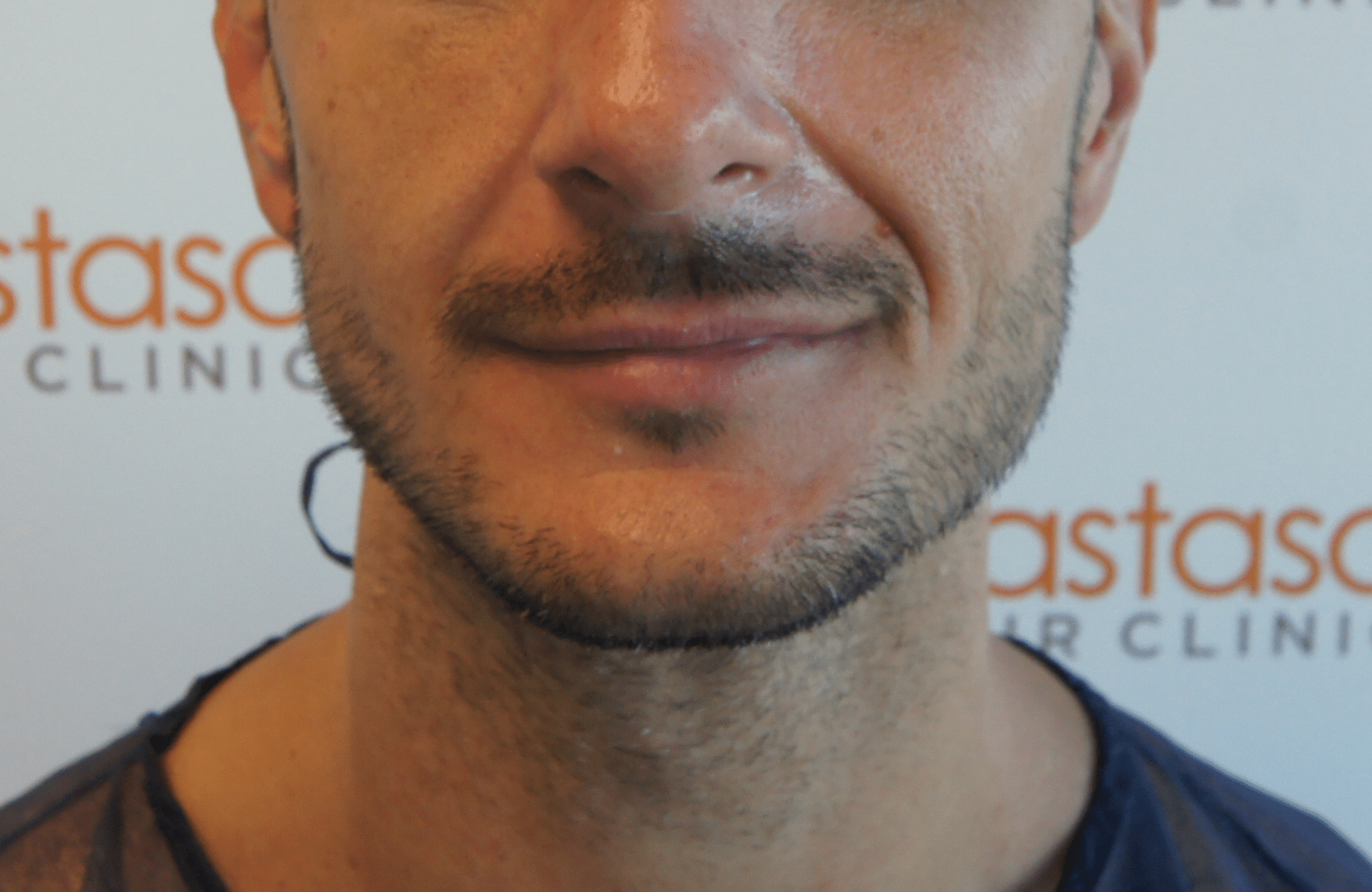 beard transplant result with 1000 follicular units - before jaw