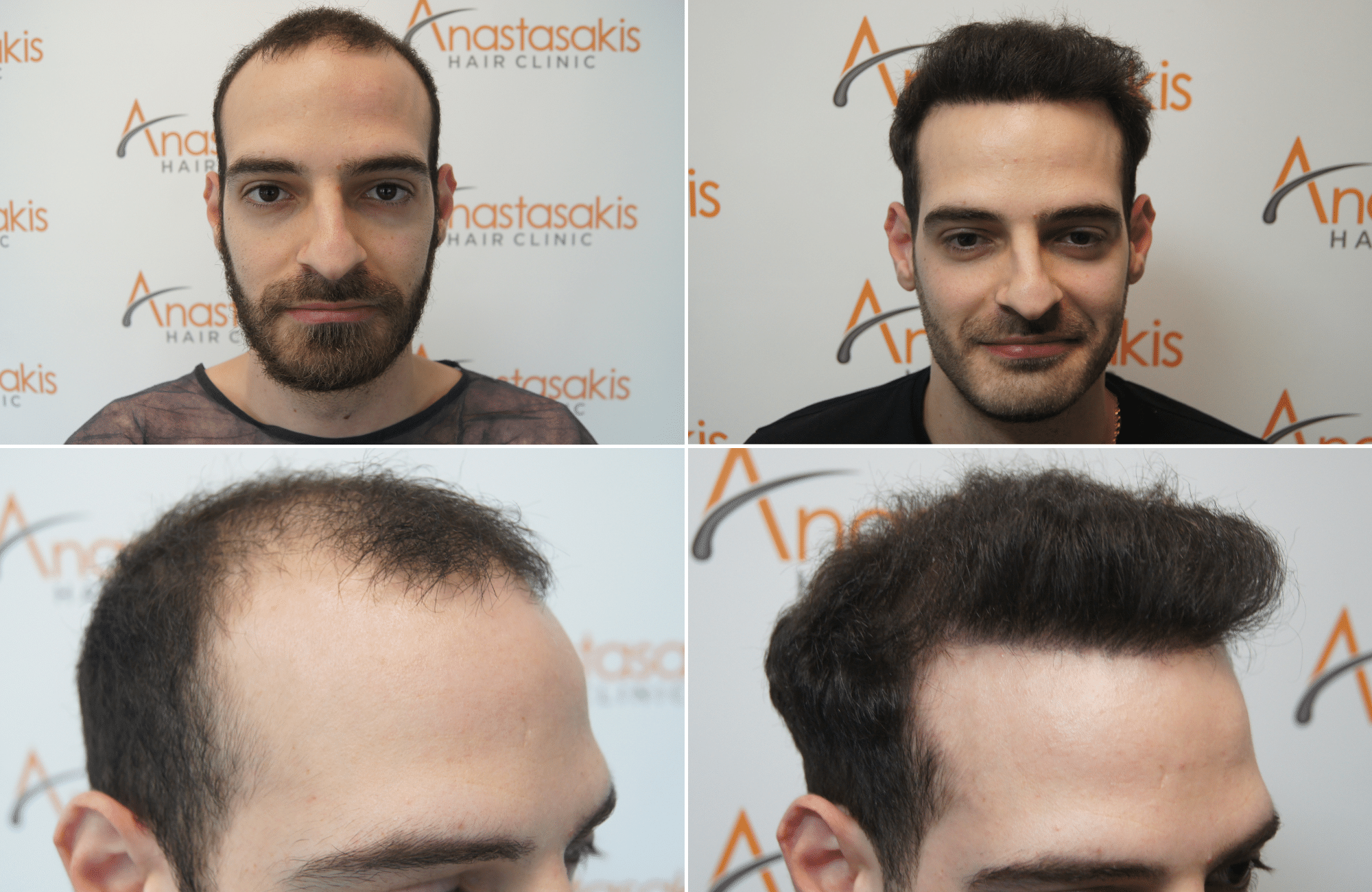 https://anastasakishairclinic.com/portfolio/apotelesma-metamosxefsis-mallion-anastasakis-hair-clinic-433/