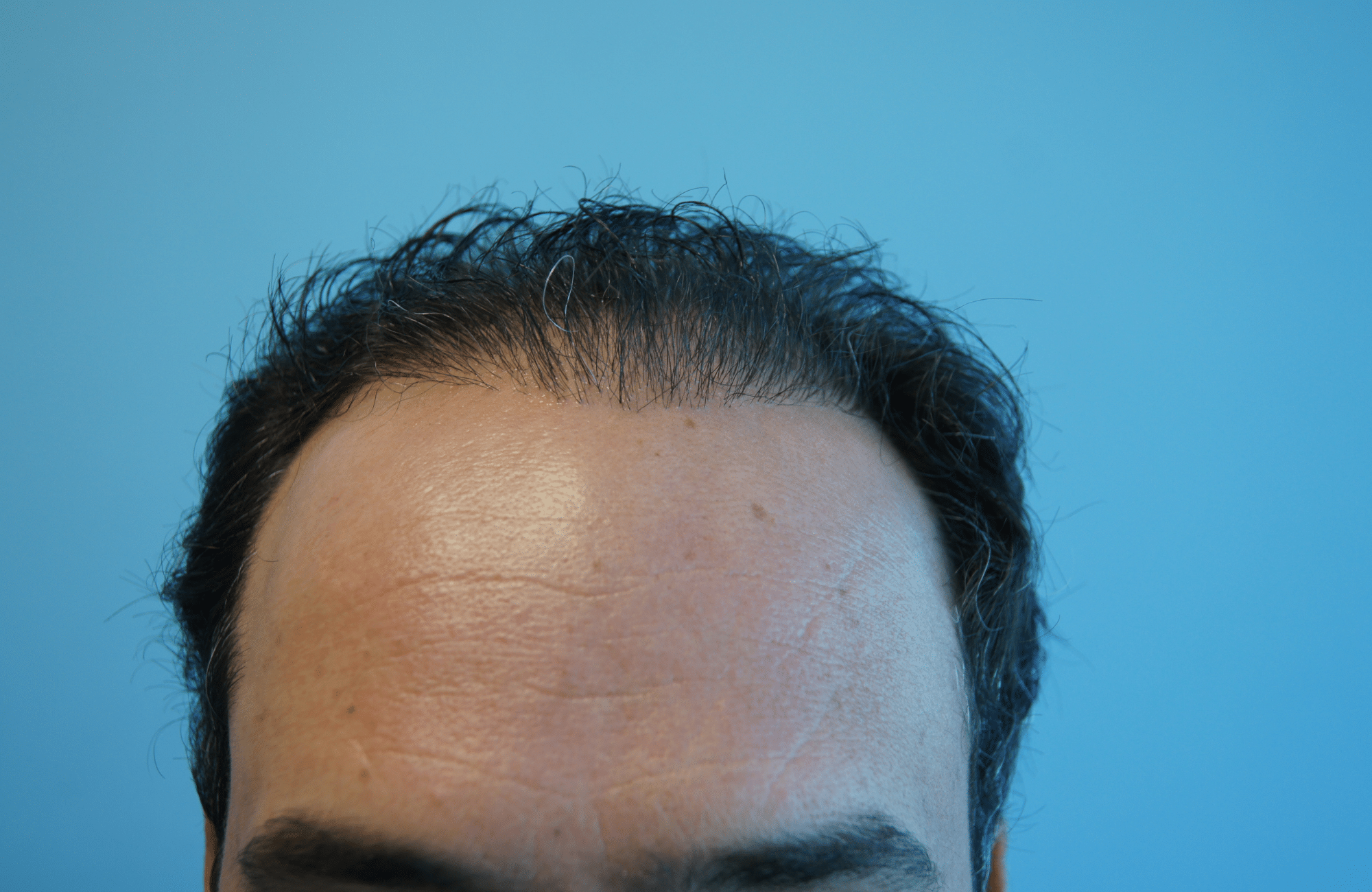 hair transplant result with 3500 grafts normal hair before - hairline