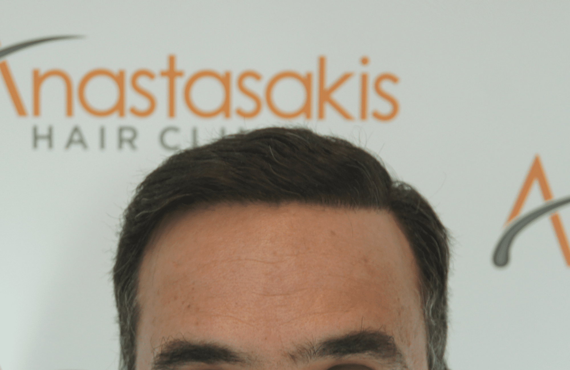 hair transplant result with 3500 grafts normal hair after - hairline