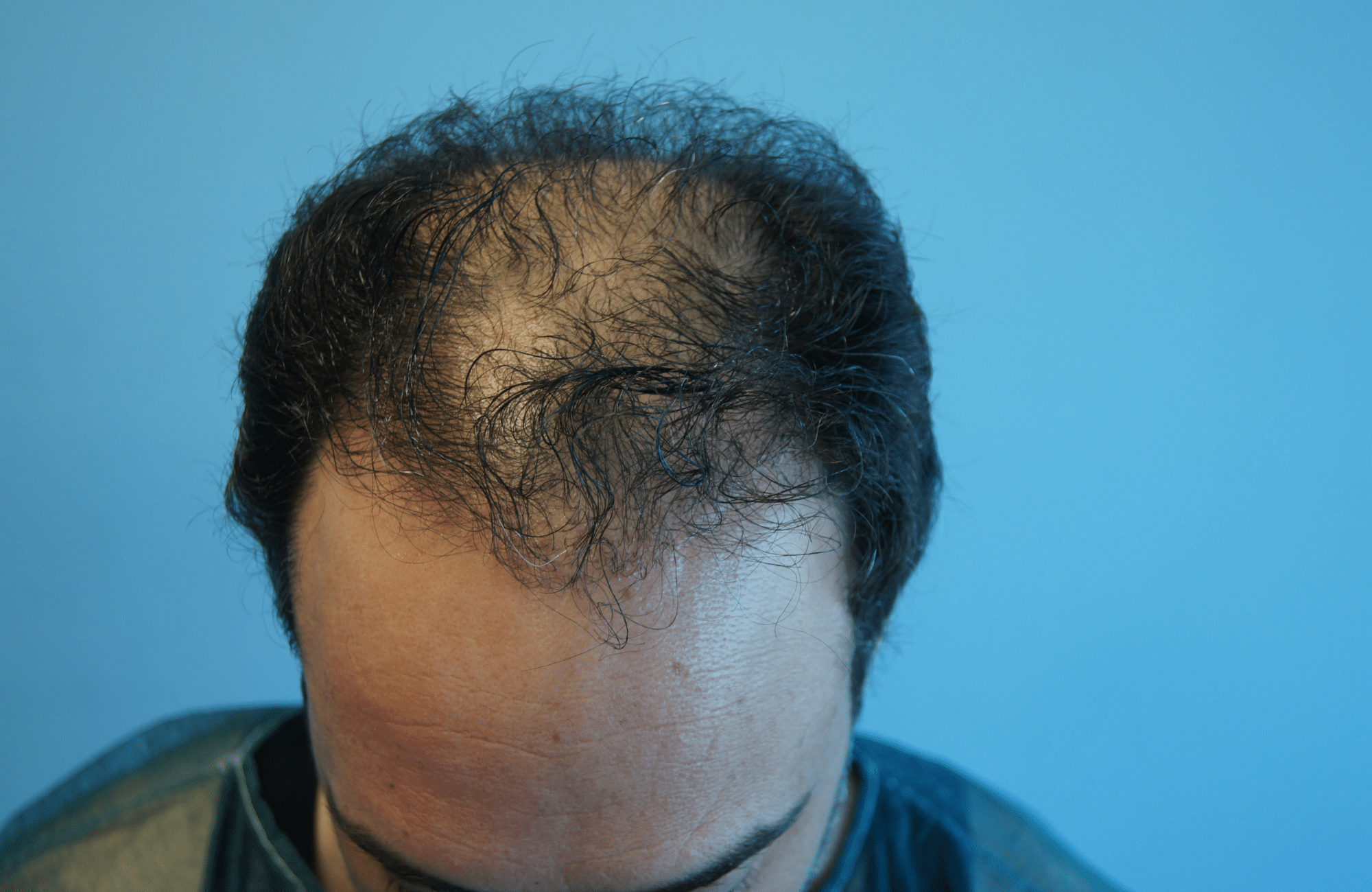hair transplant result with 3500 grafts normal hair before - frontal