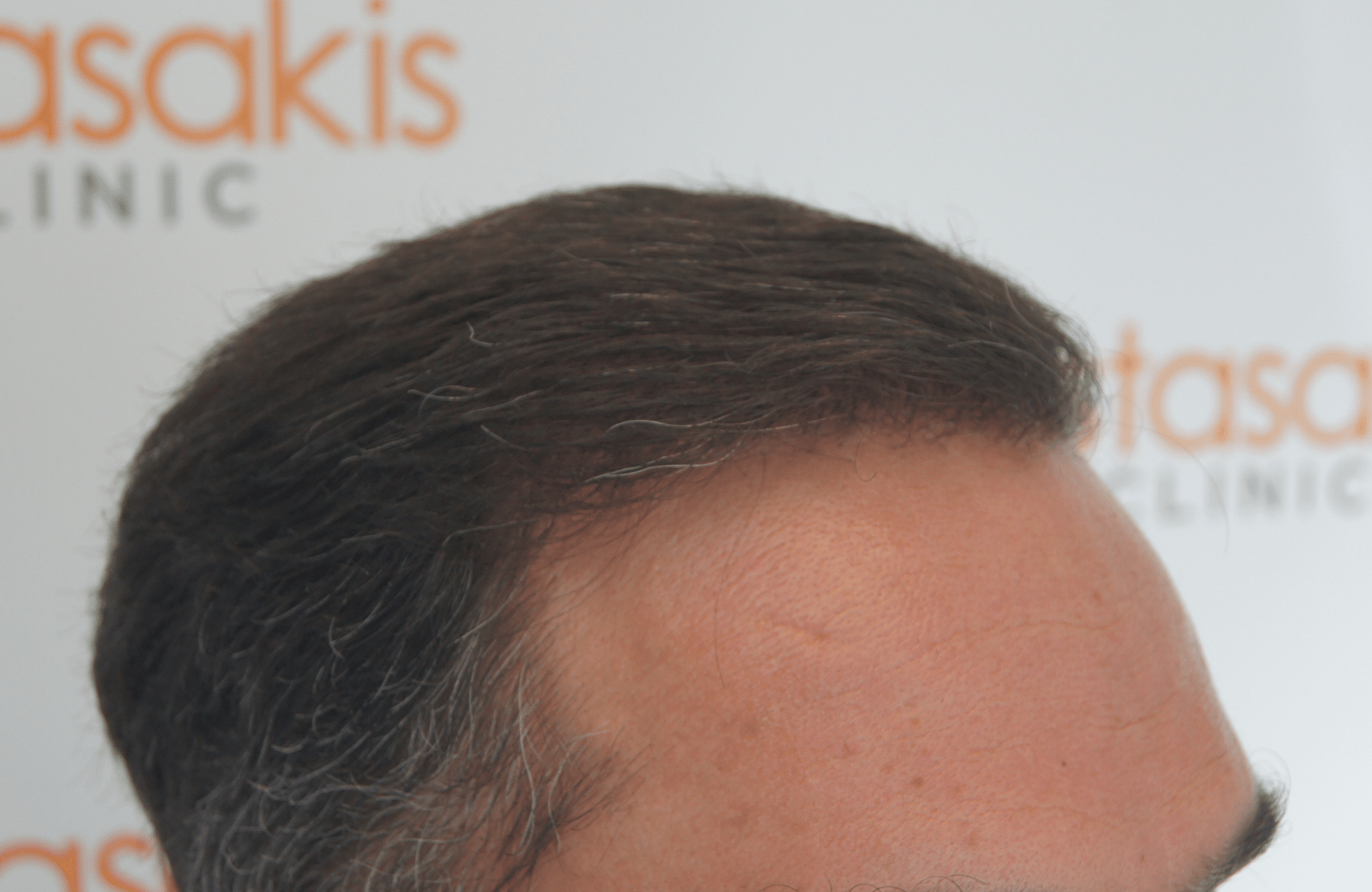 hair transplant result with 3500 grafts normal hair after - side2