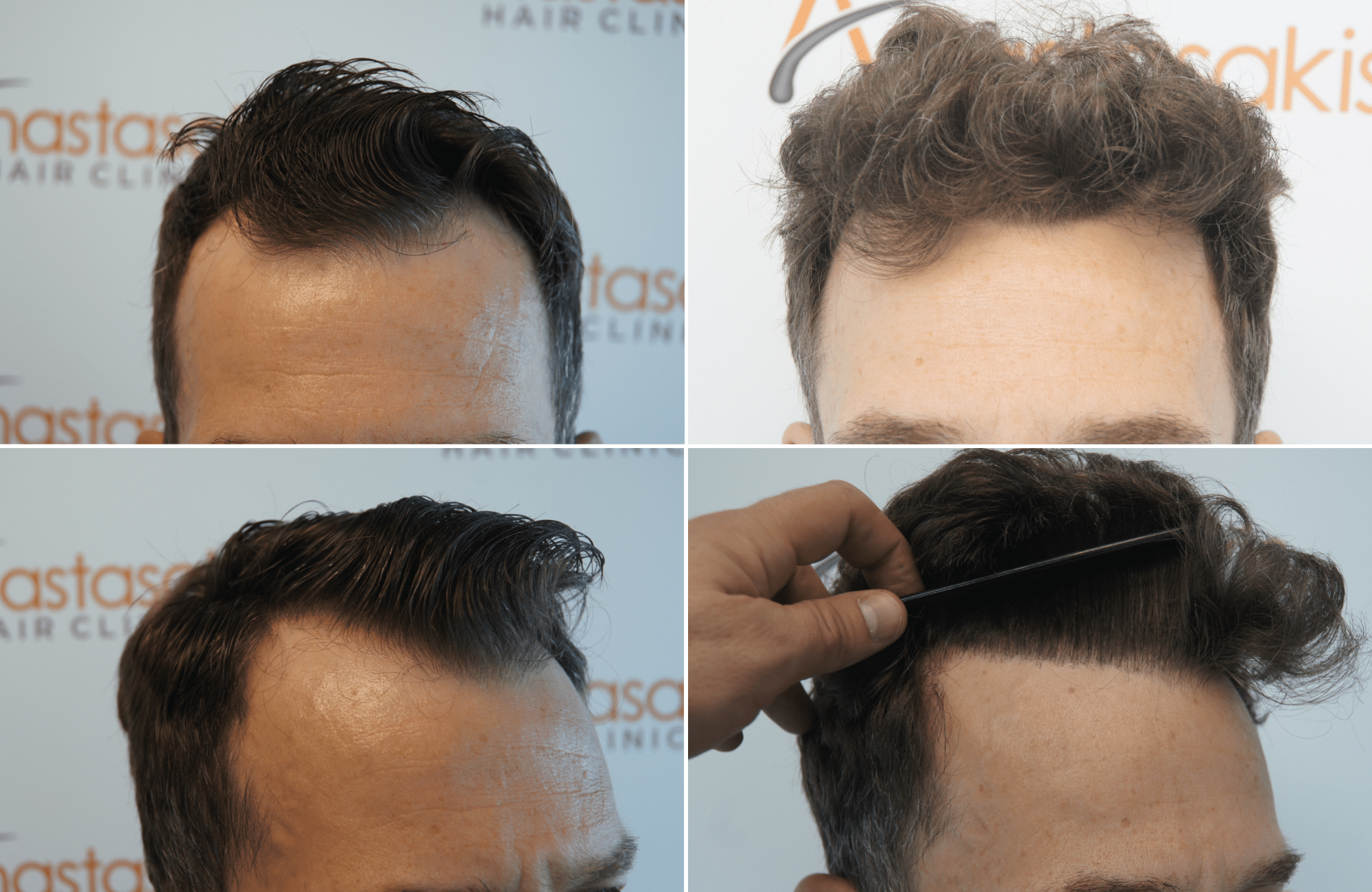 https://anastasakishairclinic.com/portfolio/apotelesma-metamosxefsis-mallion-anastasakis-hair-clinic-415/