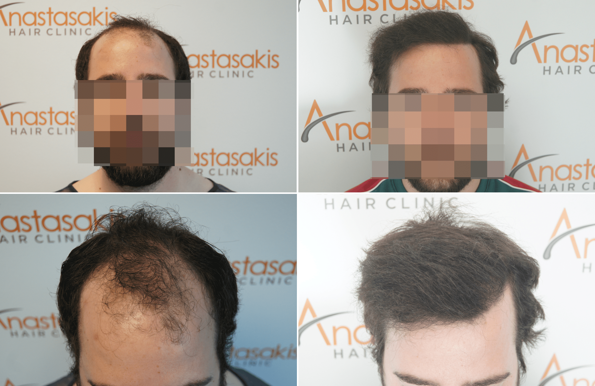 https://anastasakishairclinic.com/portfolio/apotelesma-metamosxefsis-mallion-anastasakis-hair-clinic-417/