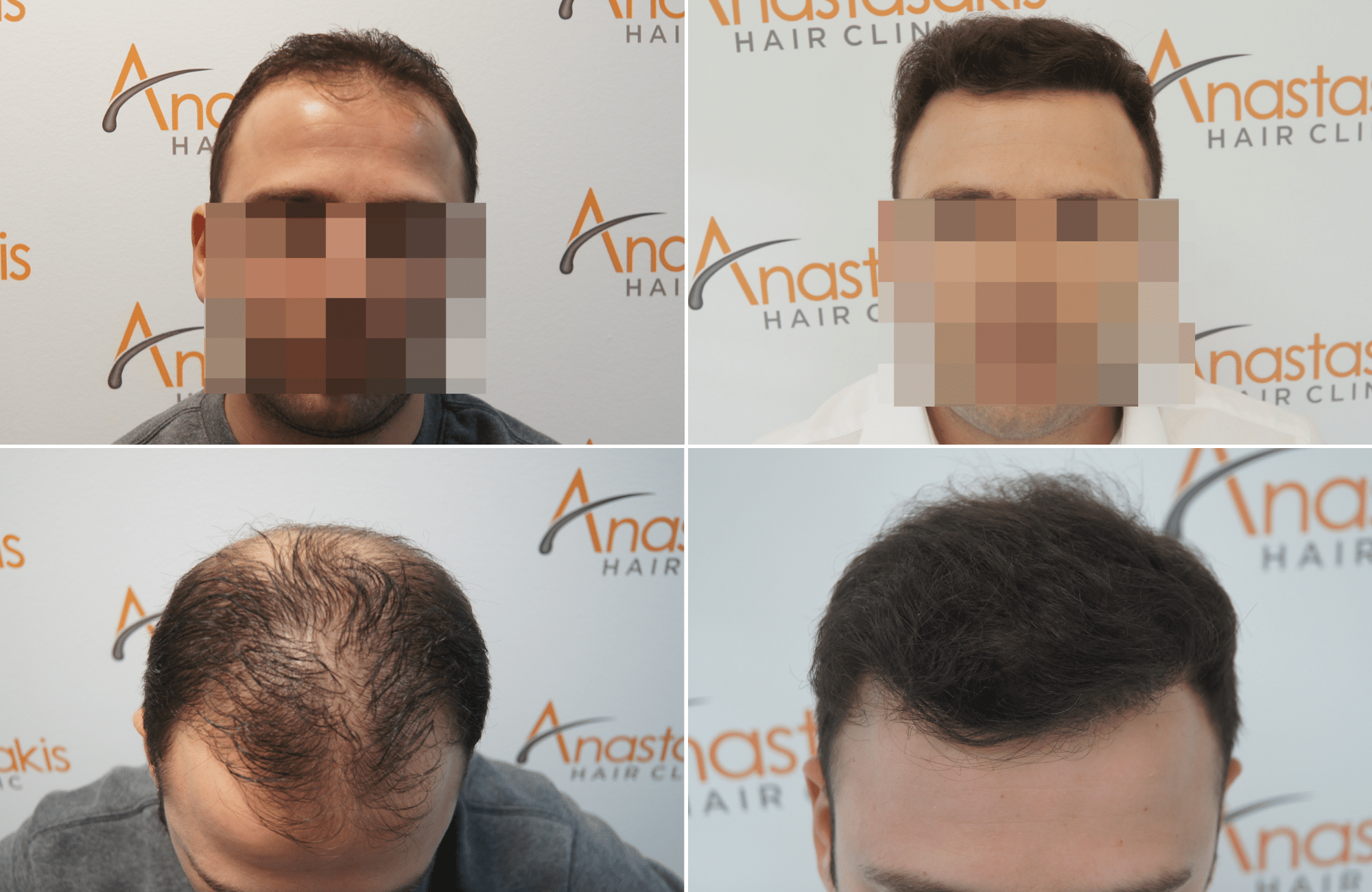 https://anastasakishairclinic.com/portfolio/apotelesma-metamosxefsis-mallion-anastasakis-hair-clinic-418/