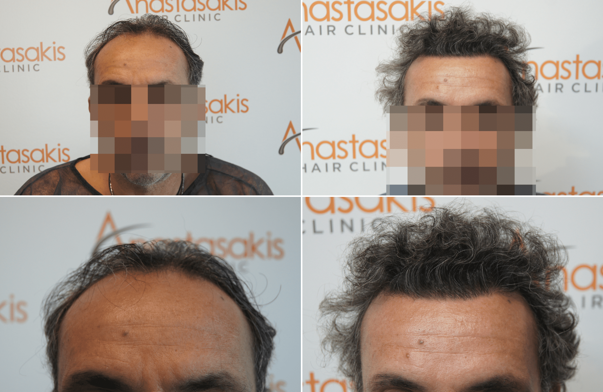 https://anastasakishairclinic.com/portfolio/apotelesma-metamosxefsis-mallion-anastasakis-hair-clinic-419/