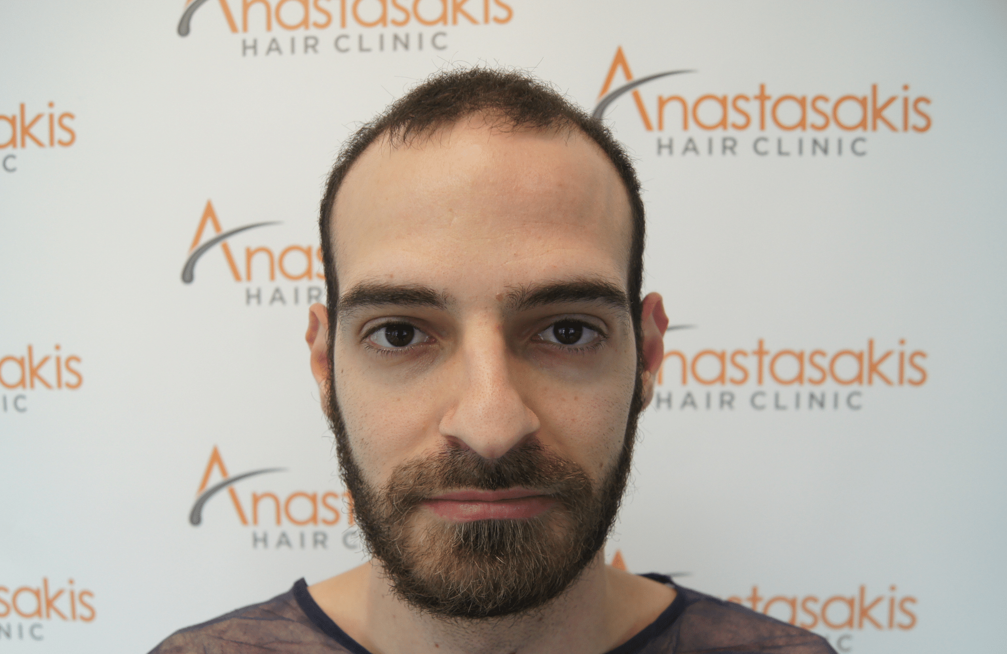 hair transplant result with 2000 grafts - before - fullface