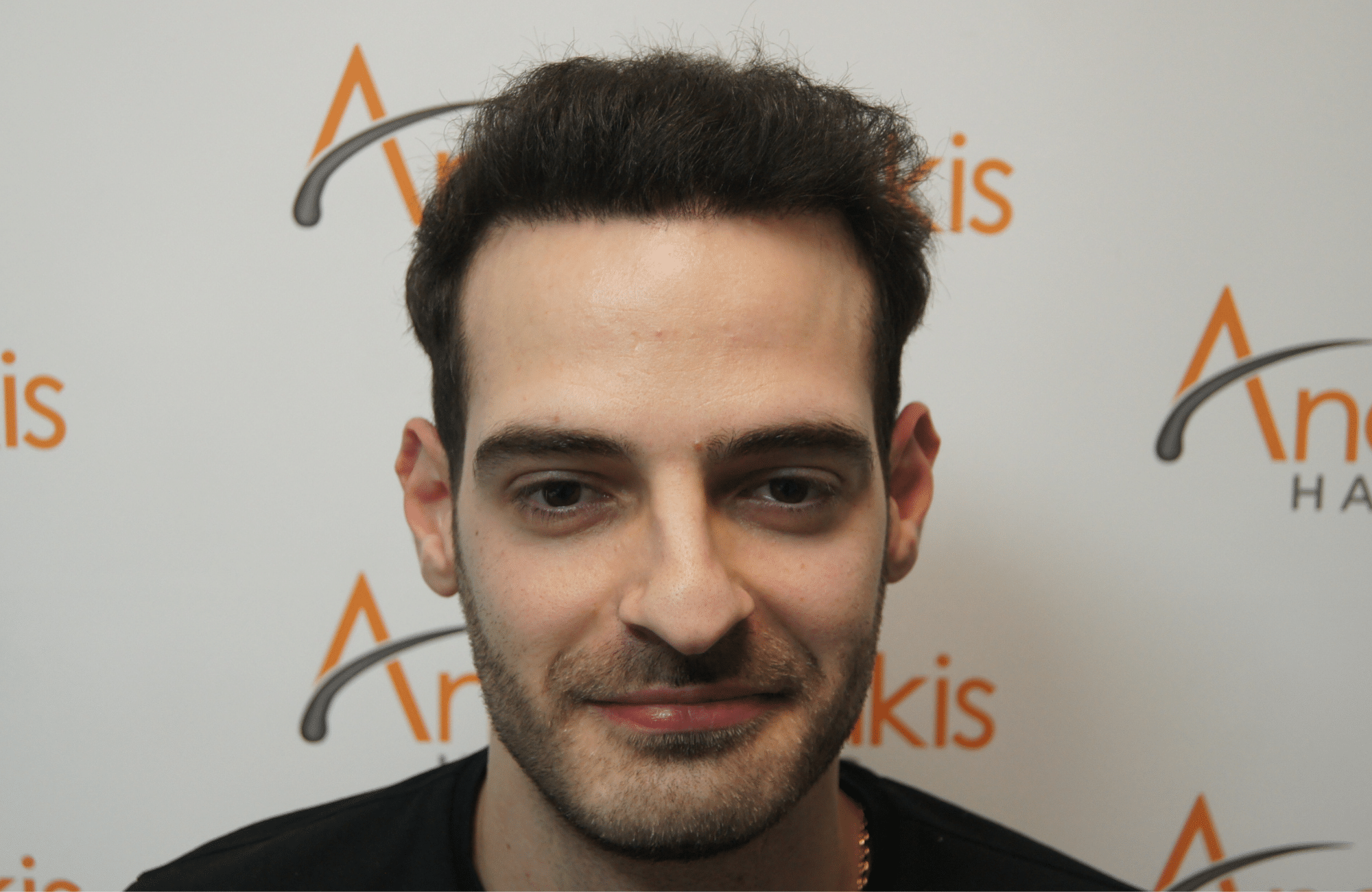 hair transplant result with 2000 grafts - after - fullface