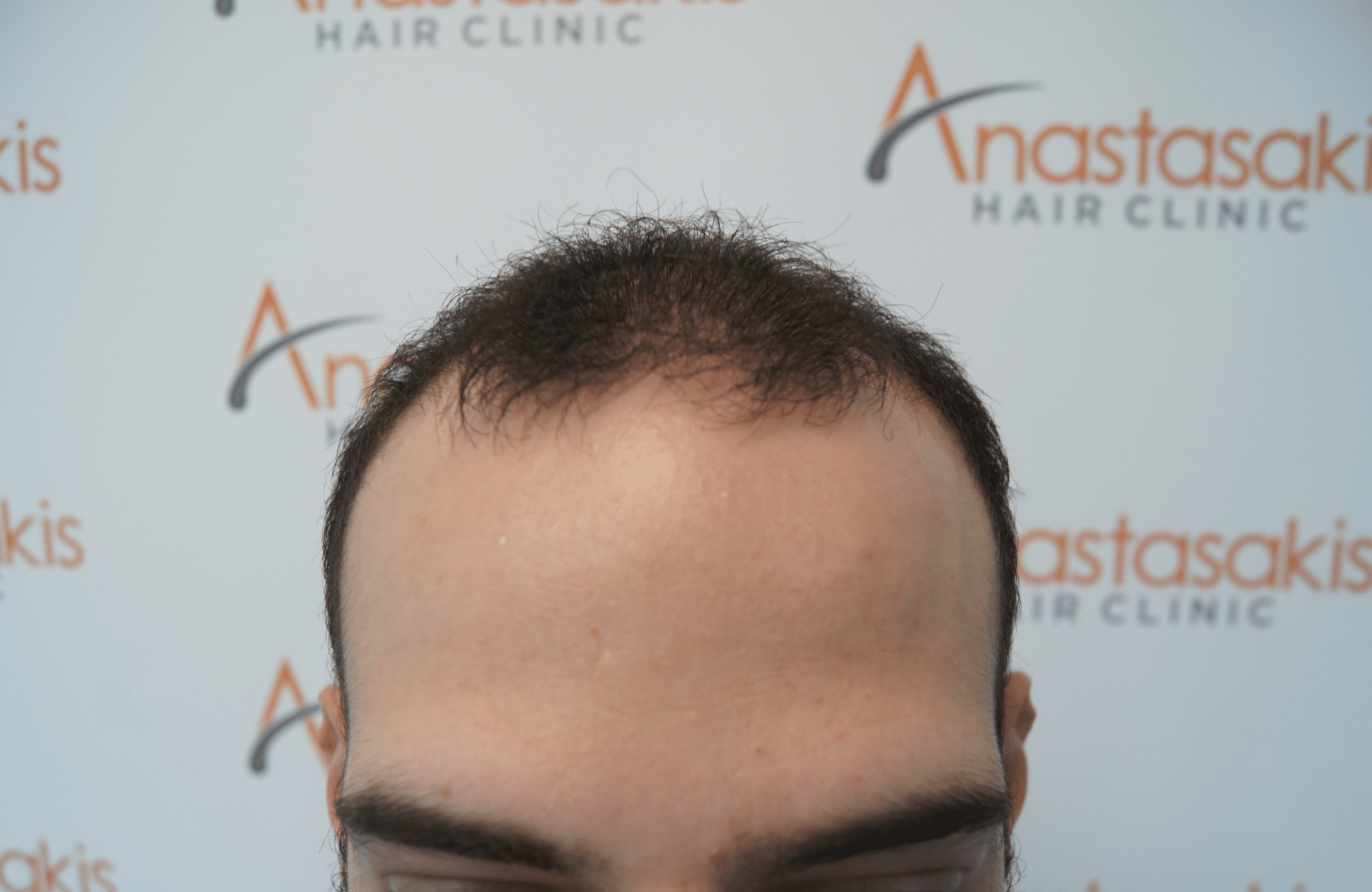 hair transplant result with 2000 grafts - before - hairline