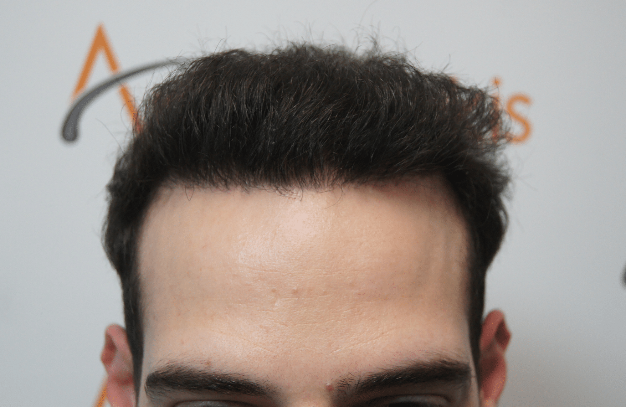 hair transplant result with 2000 grafts - after - hairline