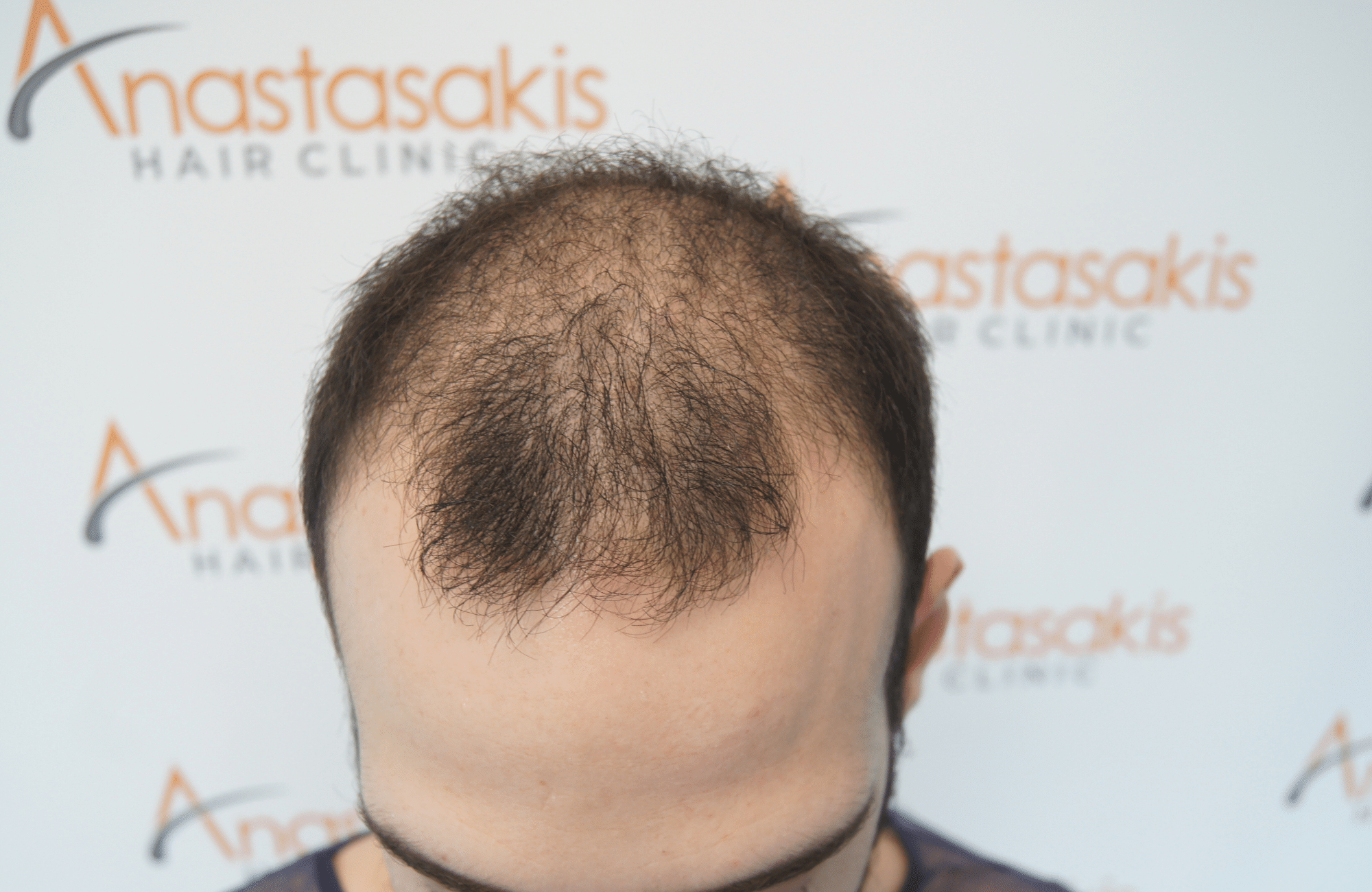 hair transplant result with 2000 grafts - before - frontal