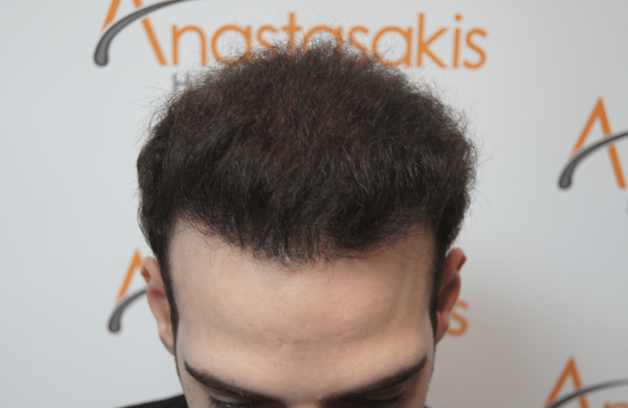 hair transplant result with 2000 grafts - after - frontal
