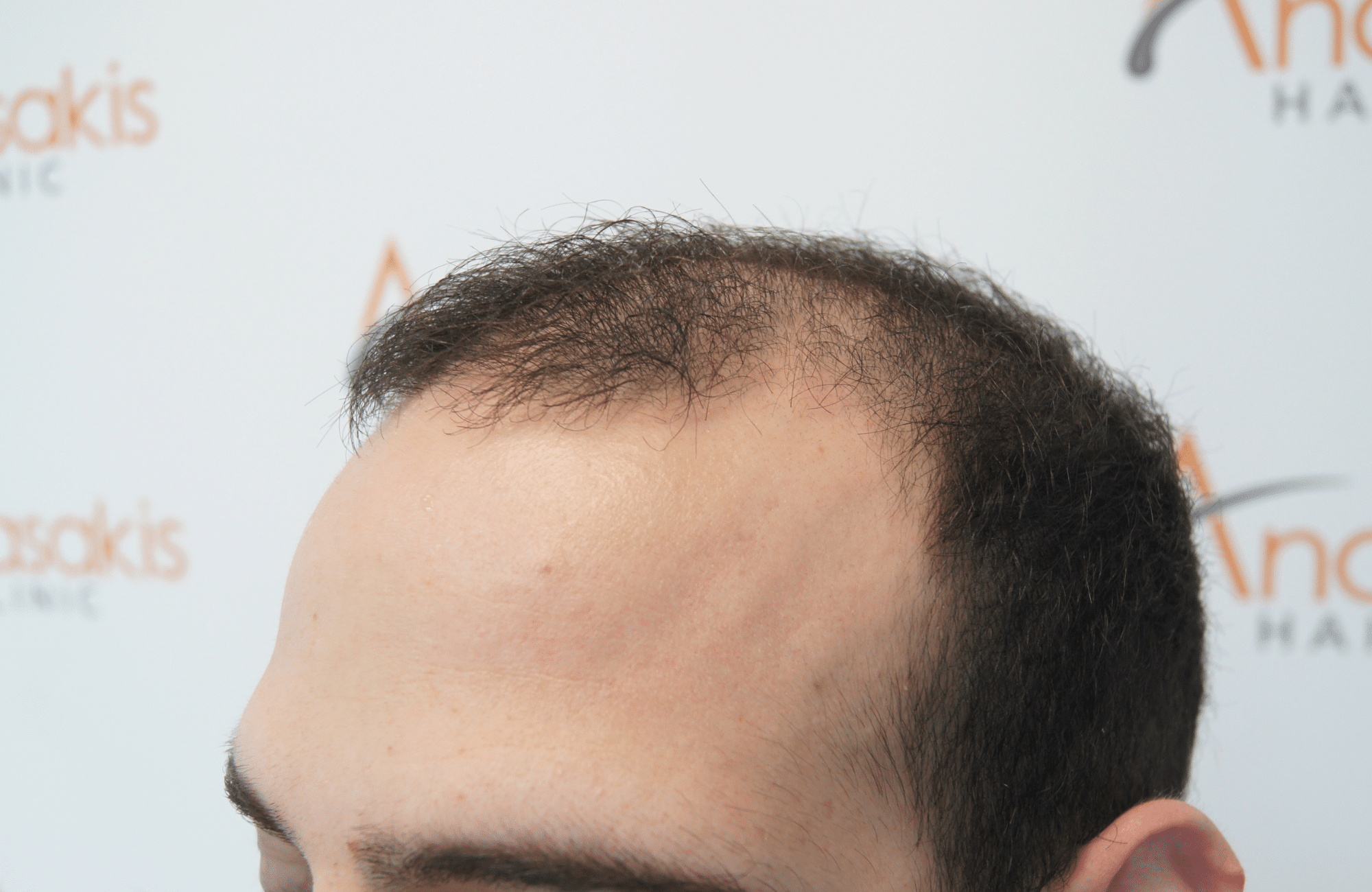 hair transplant result with 2000 grafts - before - side1