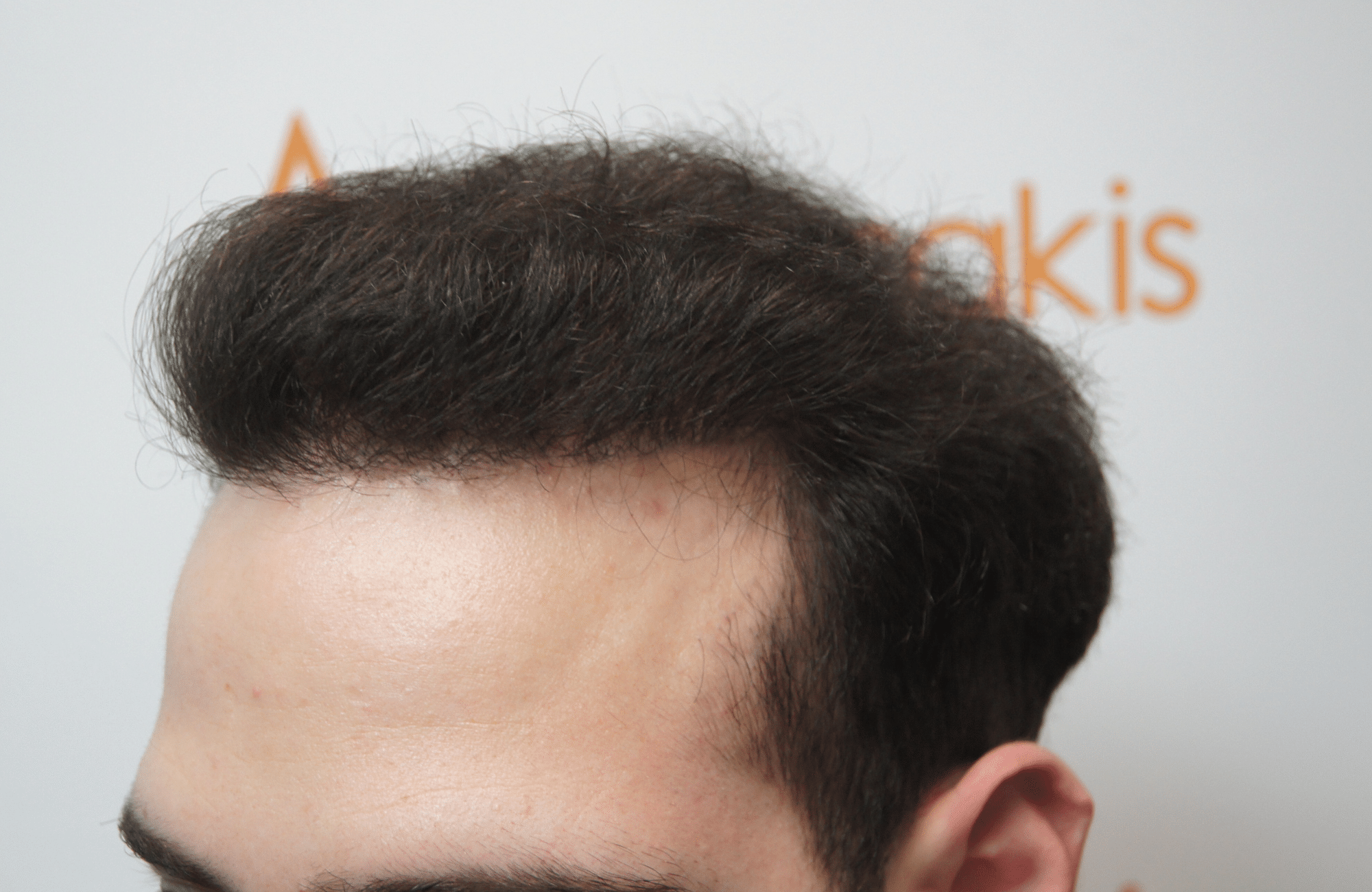 hair transplant result with 2000 grafts - after - side1
