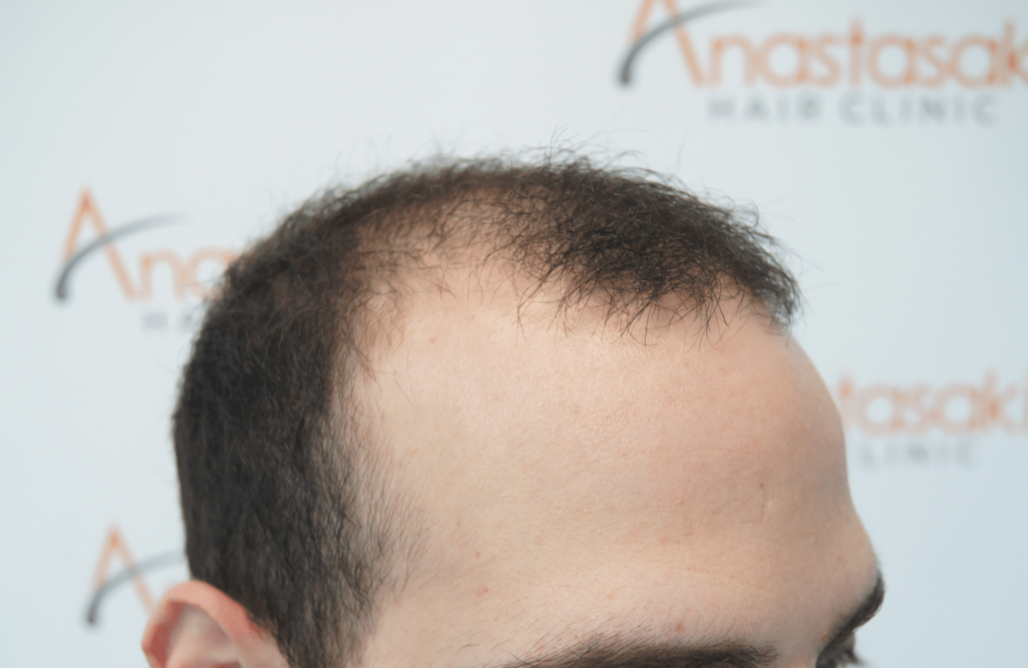 hair transplant result with 2000 grafts - before - side2