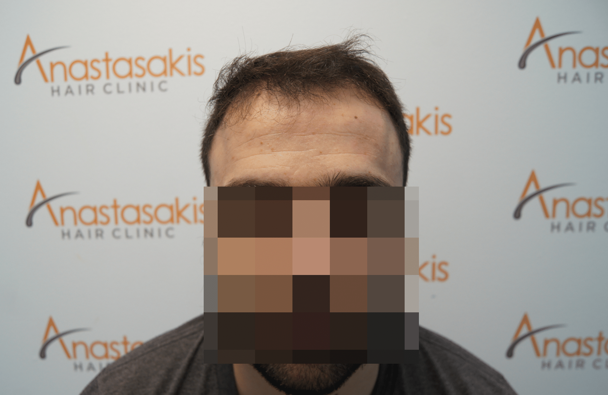 hair transplant result with 2500 grafts before - fullface