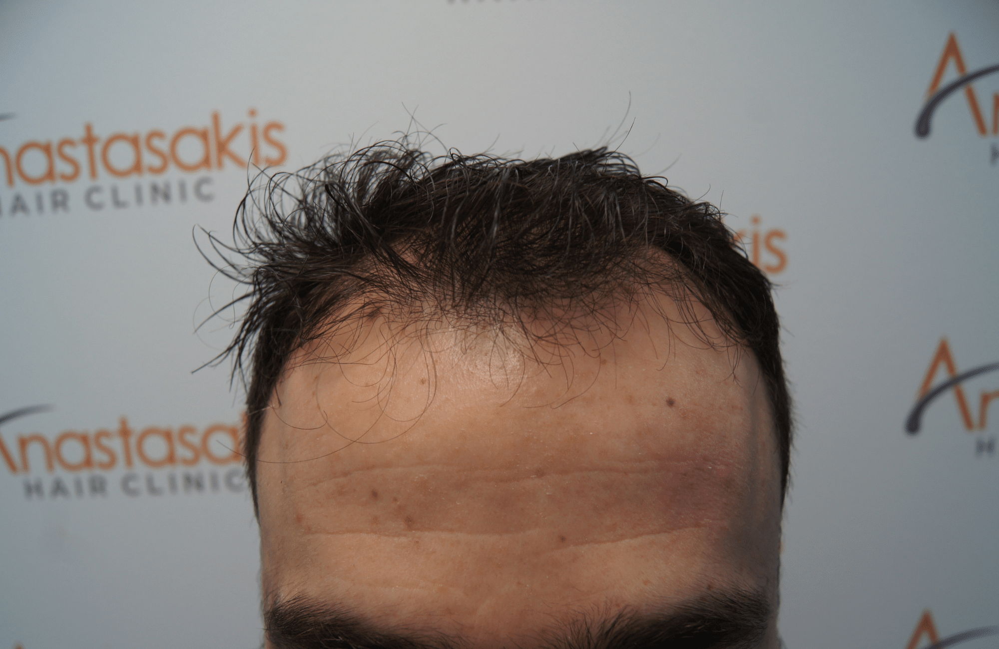 hair transplant result with 2500 grafts before - hairline