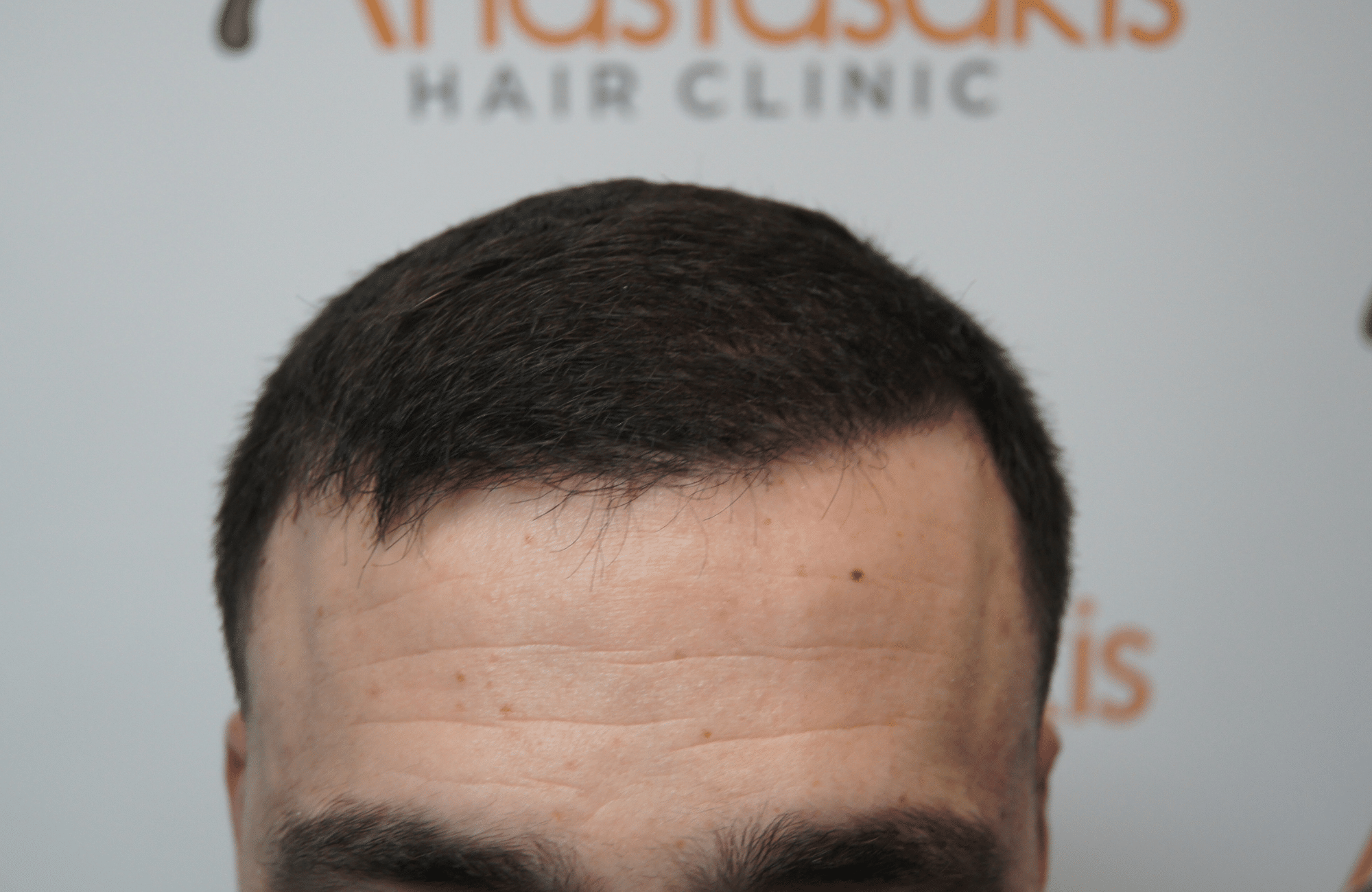 hair transplant result with 2500 grafts after - hairline