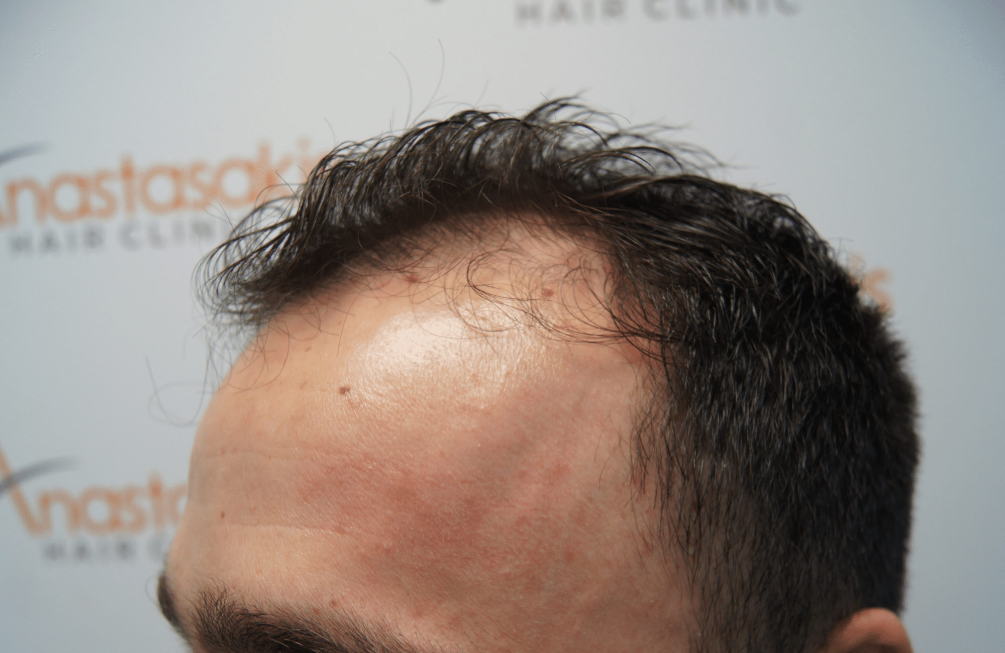 hair transplant result with 2500 grafts before - side1