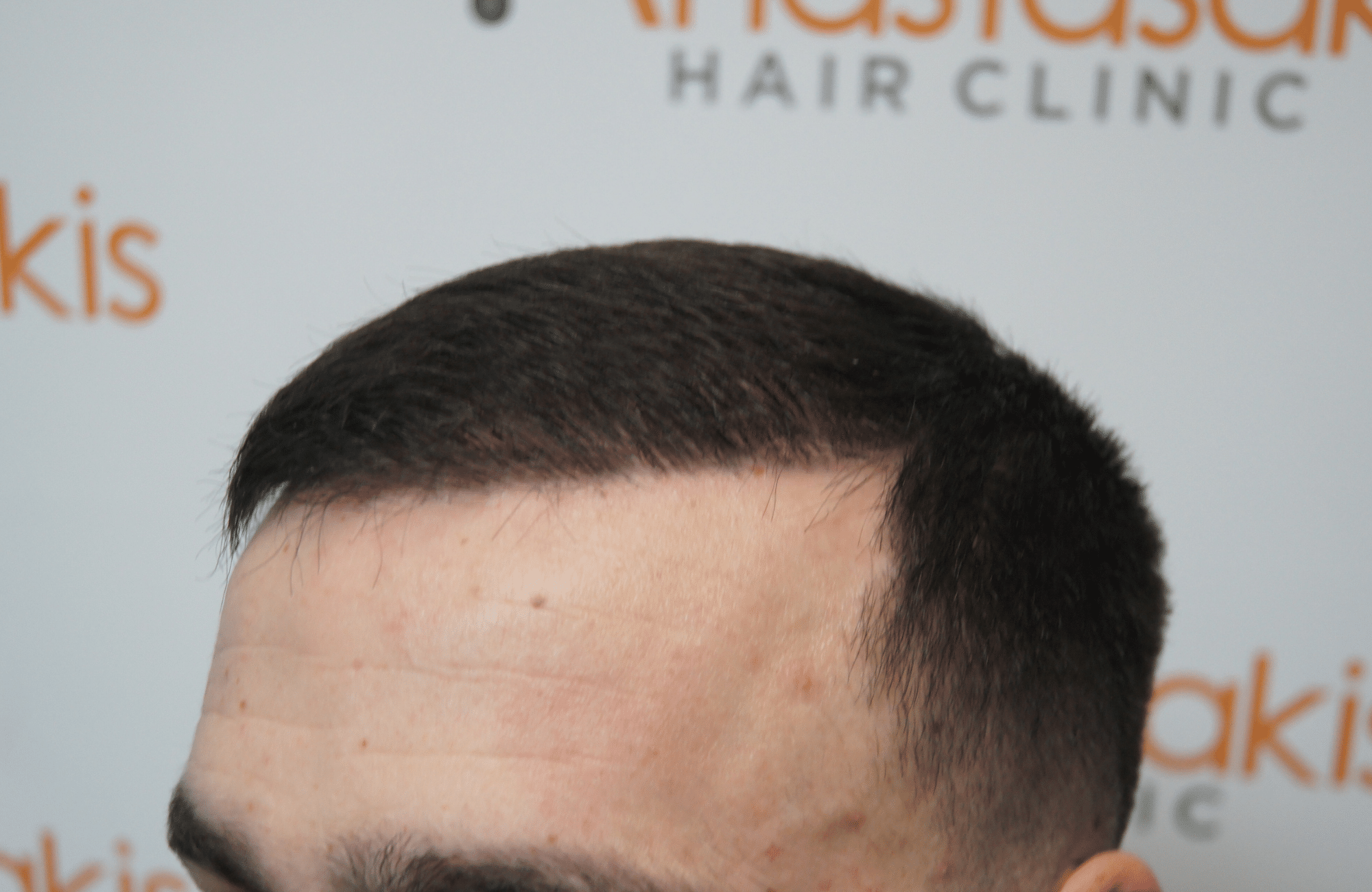 hair transplant result with 2500 grafts after - side1