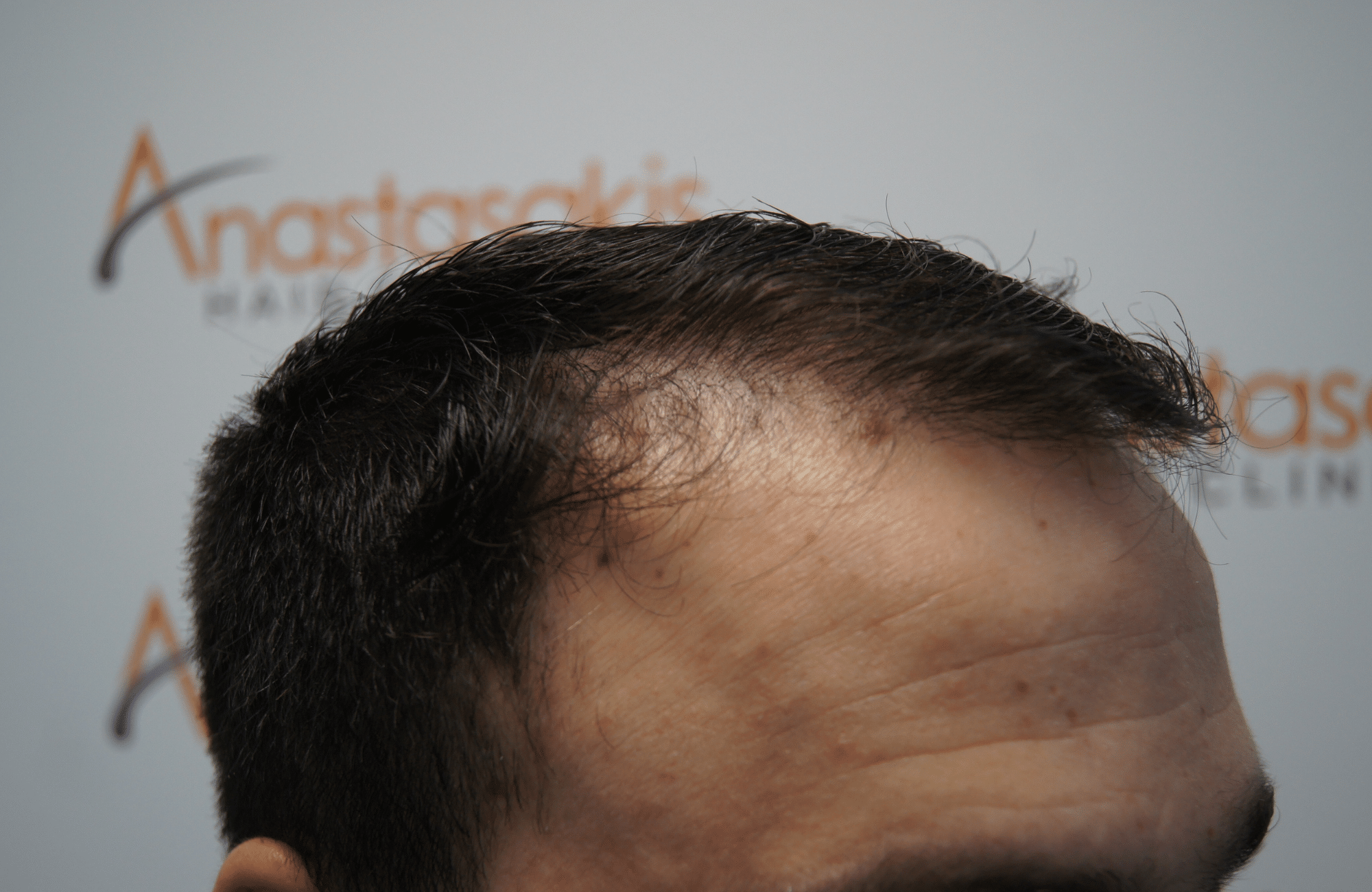 hair transplant result with 2500 grafts before - side2