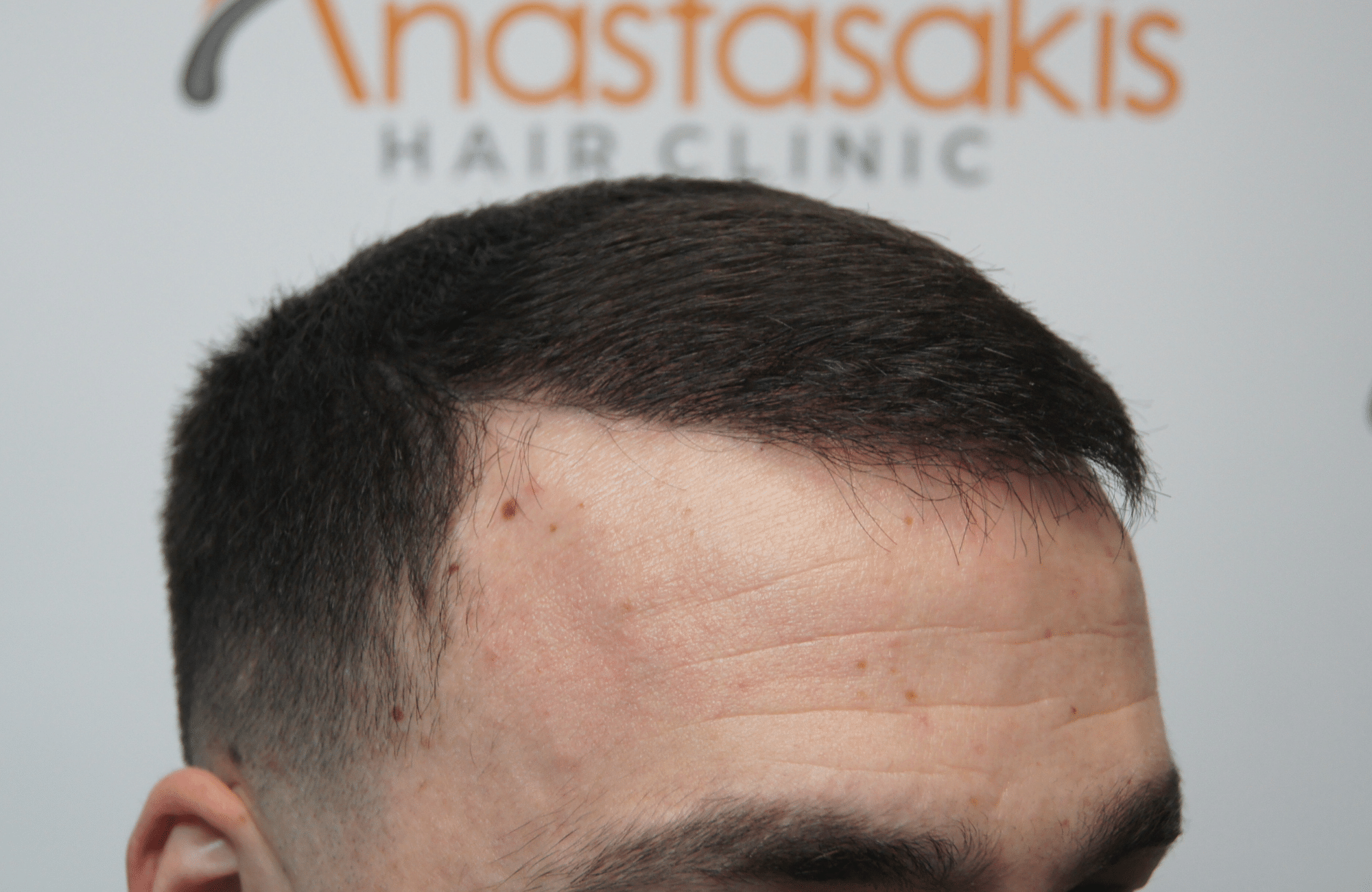 hair transplant result with 2500 grafts after - side2