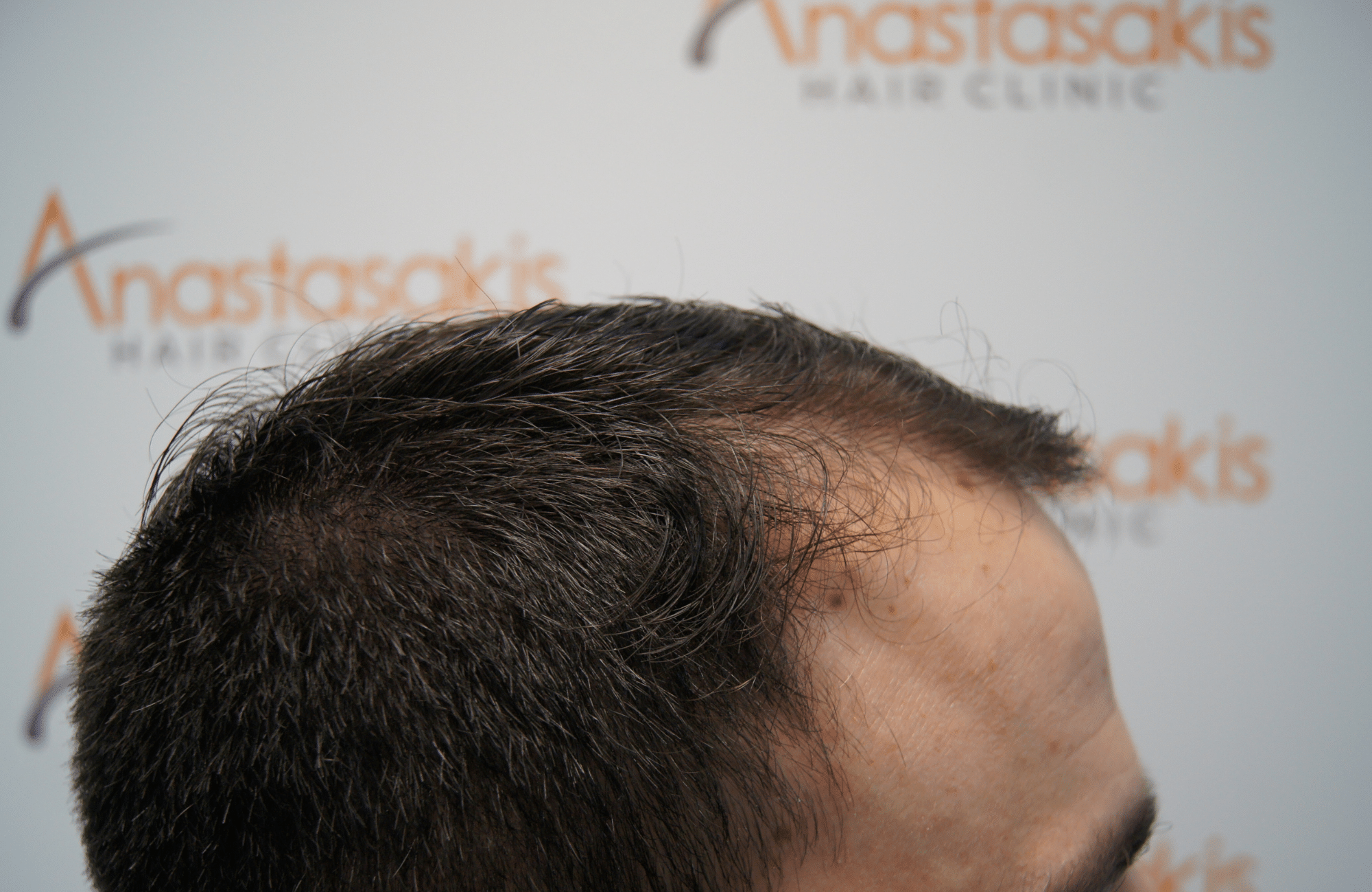 hair transplant result with 2500 grafts before - side3
