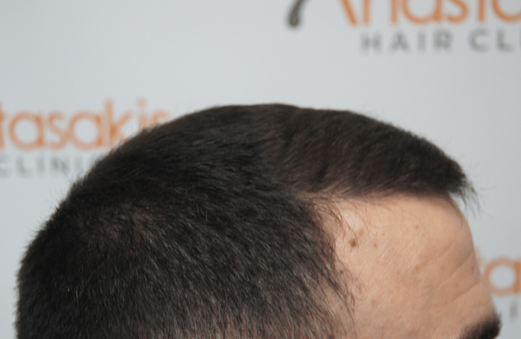 hair transplant result with 2500 grafts after - side3