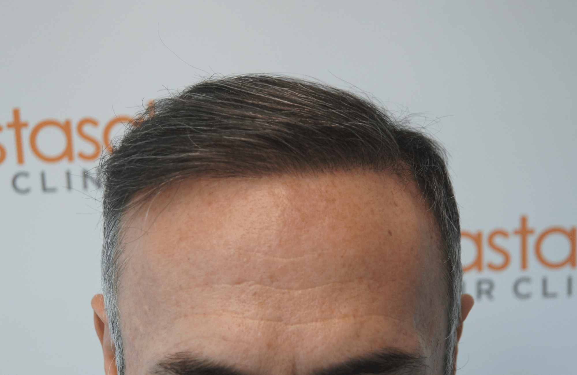 hair transplant result with 1700 grafts after - hairline